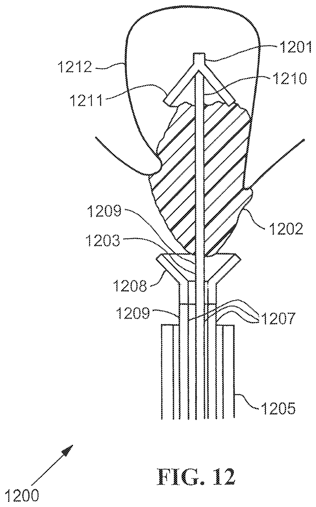 Patent US12310835 Figure 5 – Stent with expandable foam