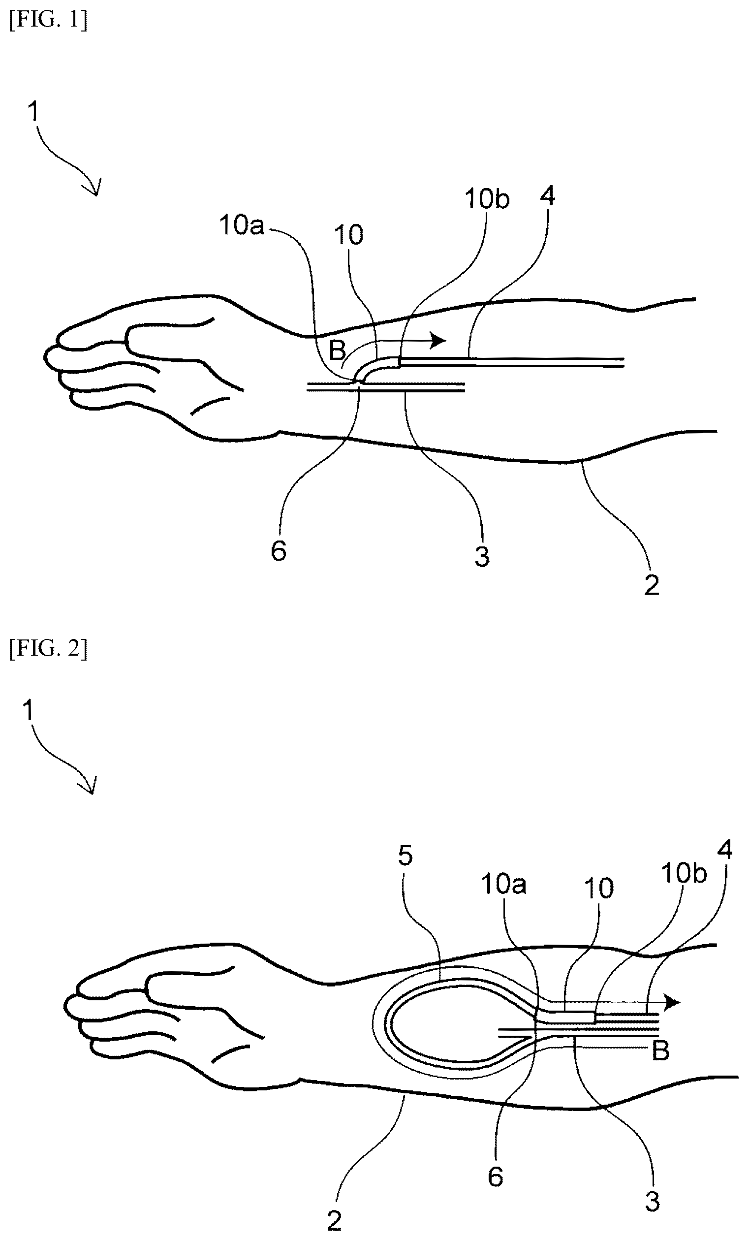 Patent US12310836 Figure 1 – Vein cover