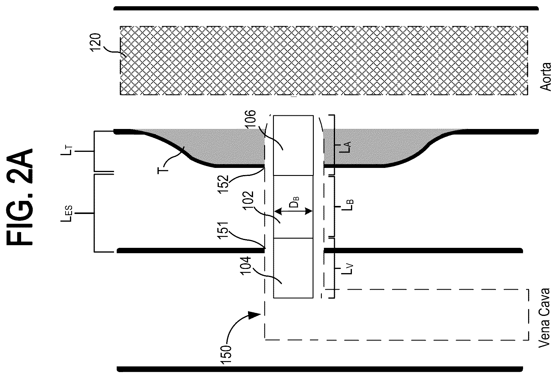 Patent US12310837 Figure 3 – Methods and systems for transcaval treatment of aneurysms
