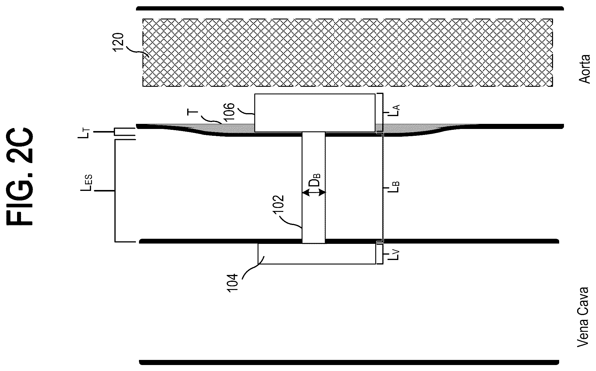 Patent US12310837 Figure 5 – Methods and systems for transcaval treatment of aneurysms