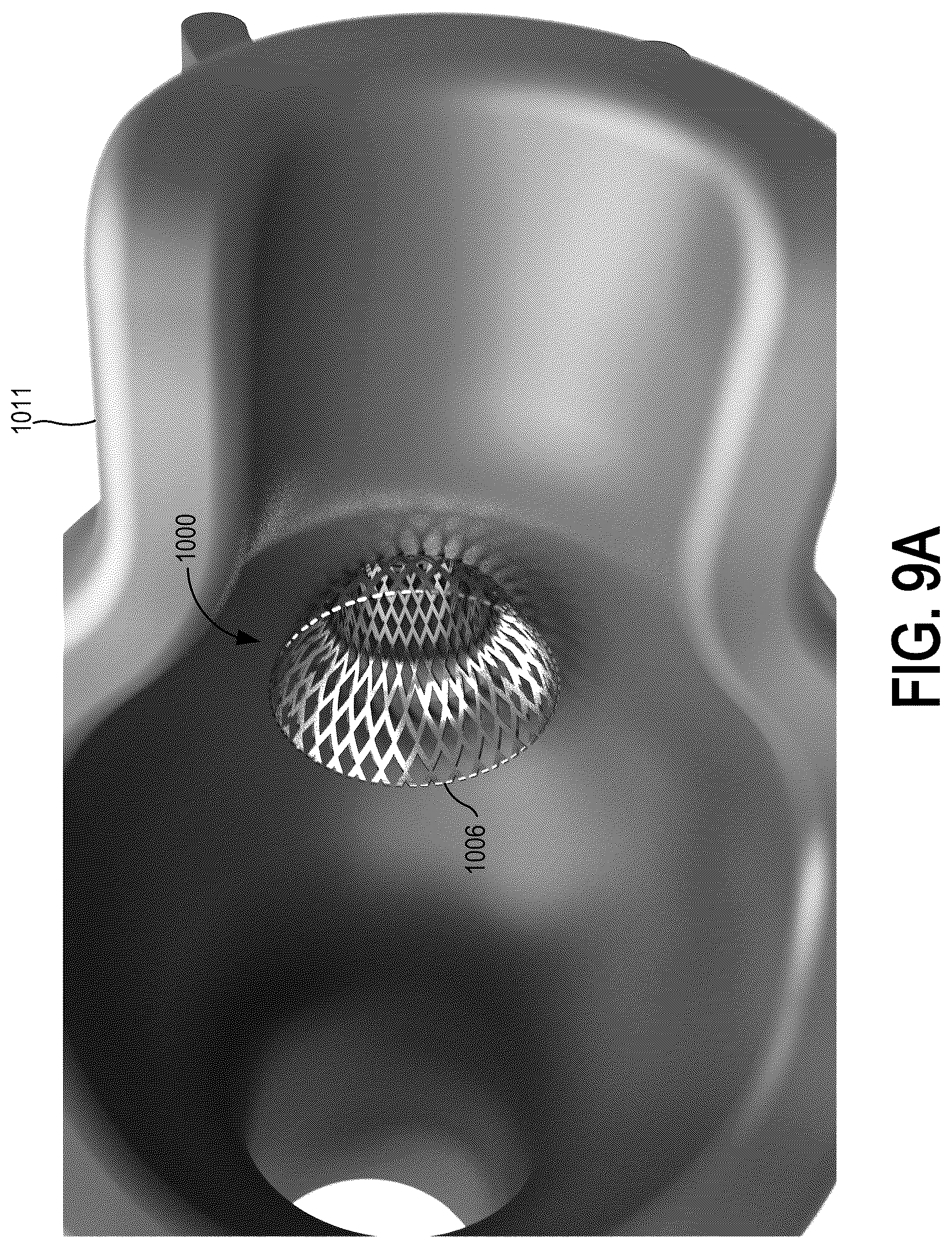 Patent US12310837 Figure 15 – Methods and systems for transcaval treatment of aneurysms