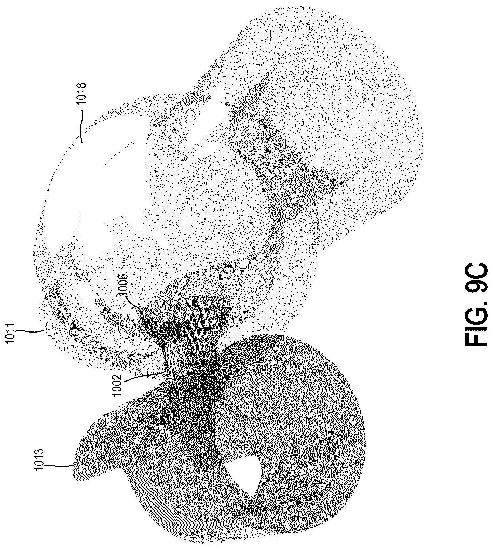 Patent US12310837 Figure 17 – Methods and systems for transcaval treatment of aneurysms