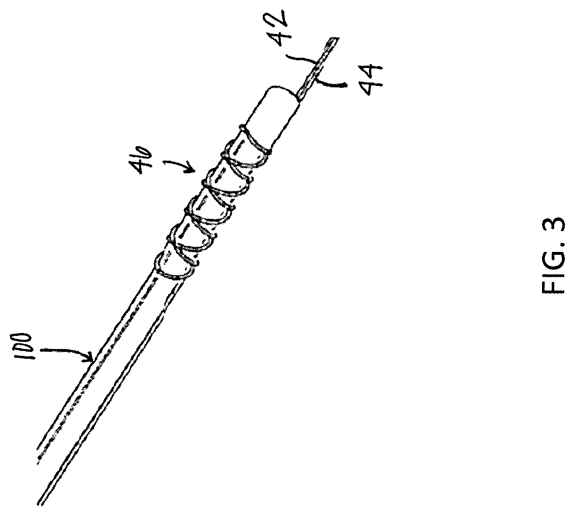 Patent US12310838 Figure 3 – System and method for preparing a soft tissue graft
