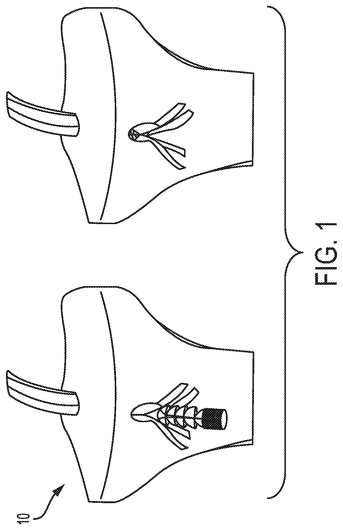 Patent US12310839 Figure 1 – Expanding anchor