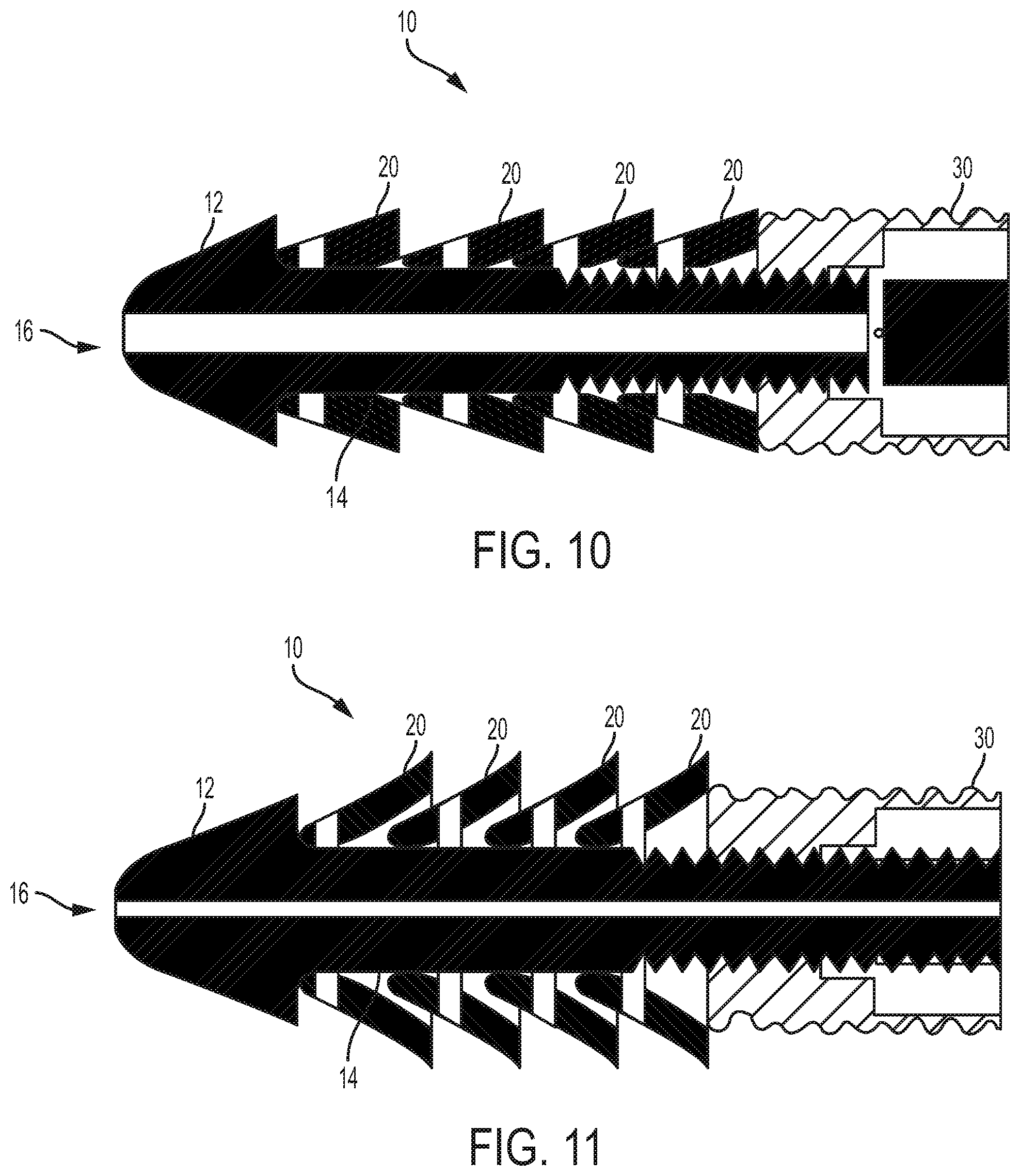Patent US12310839 Figure 6 – Expanding anchor