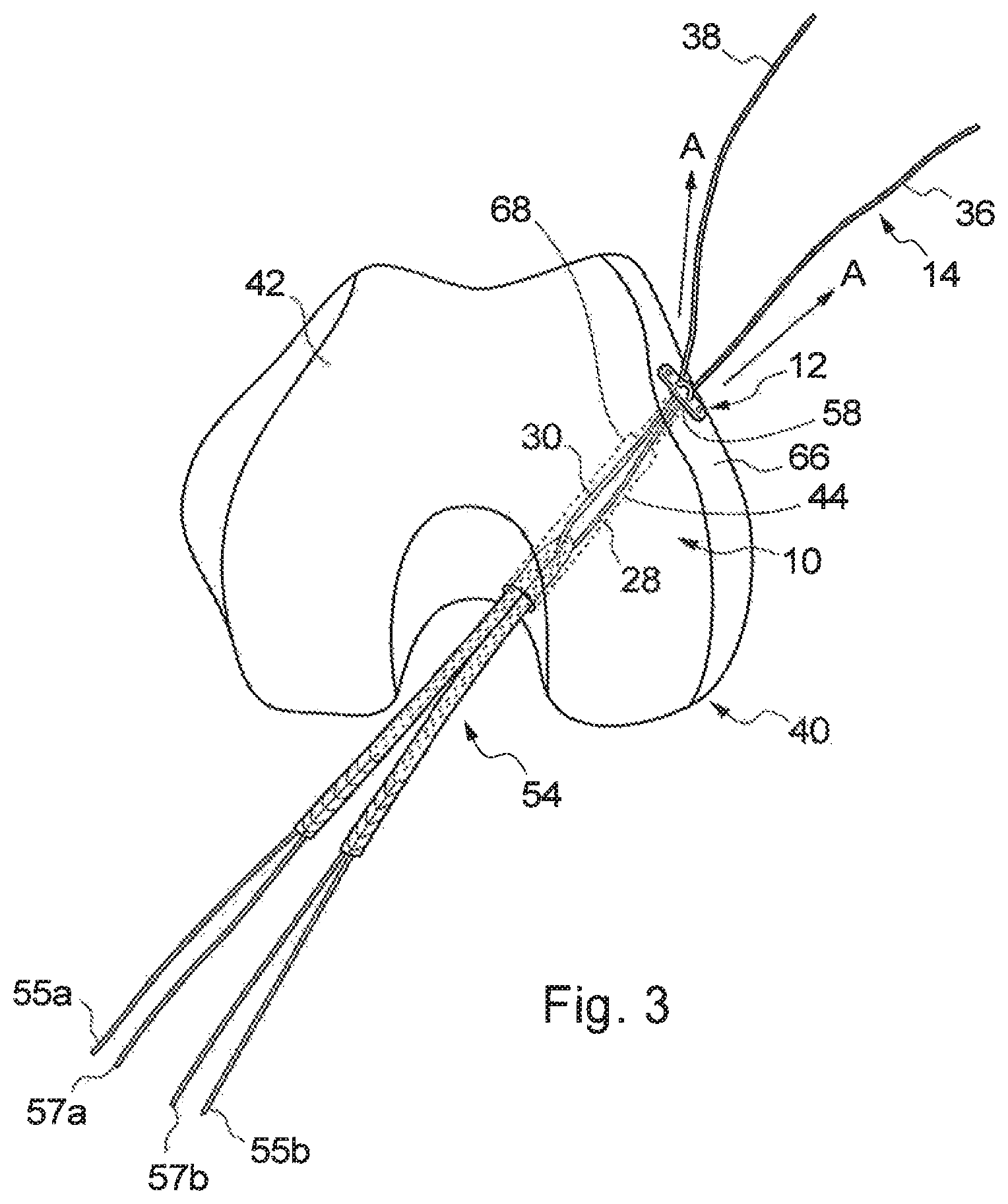 Patent US12310840 Figure 3 – Implant assembly and associated methods of manufacturing