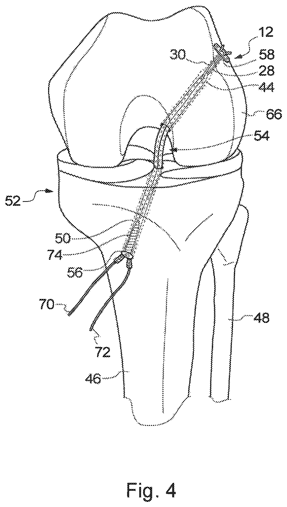 Patent US12310840 Figure 4 – Implant assembly and associated methods of manufacturing