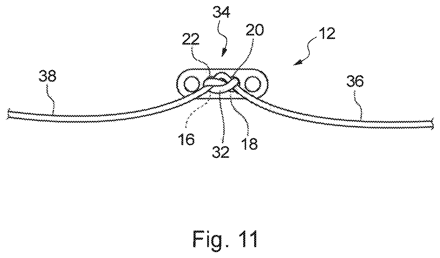 Patent US12310840 Figure 11 – Implant assembly and associated methods of manufacturing