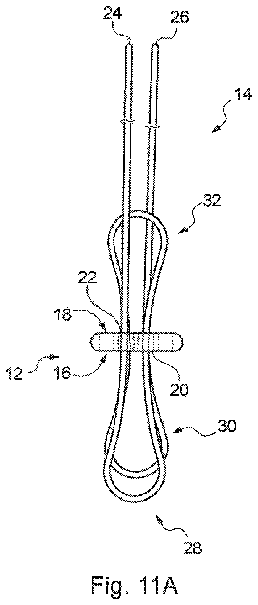 Patent US12310840 Figure 12 – Implant assembly and associated methods of manufacturing