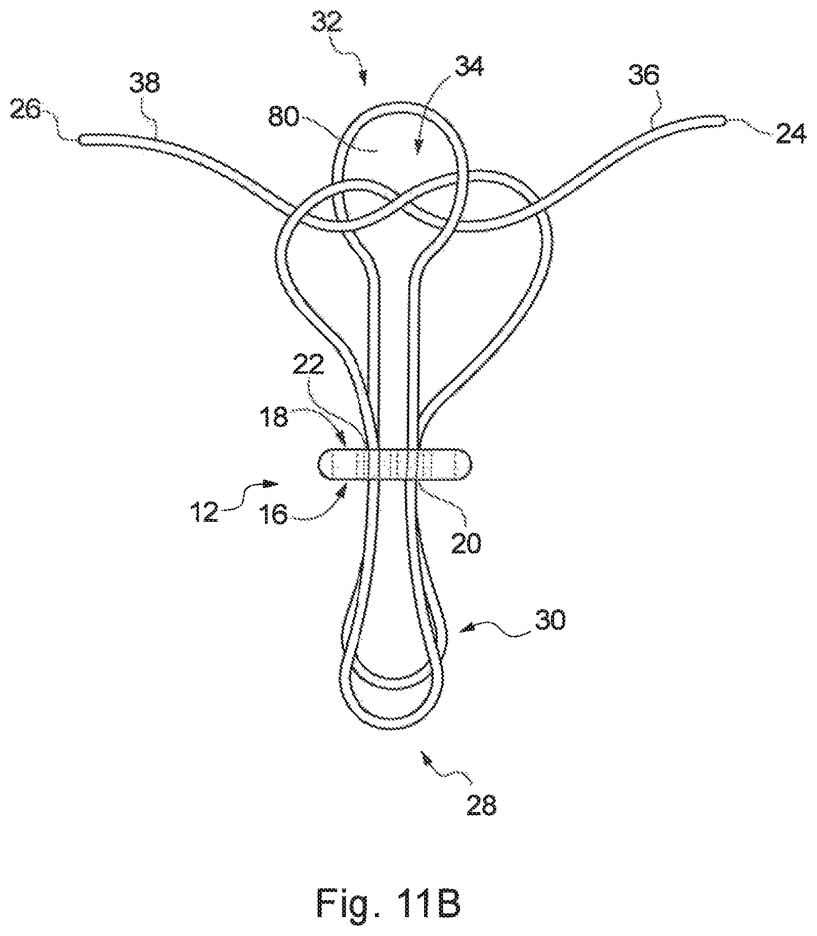 Patent US12310840 Figure 13 – Implant assembly and associated methods of manufacturing