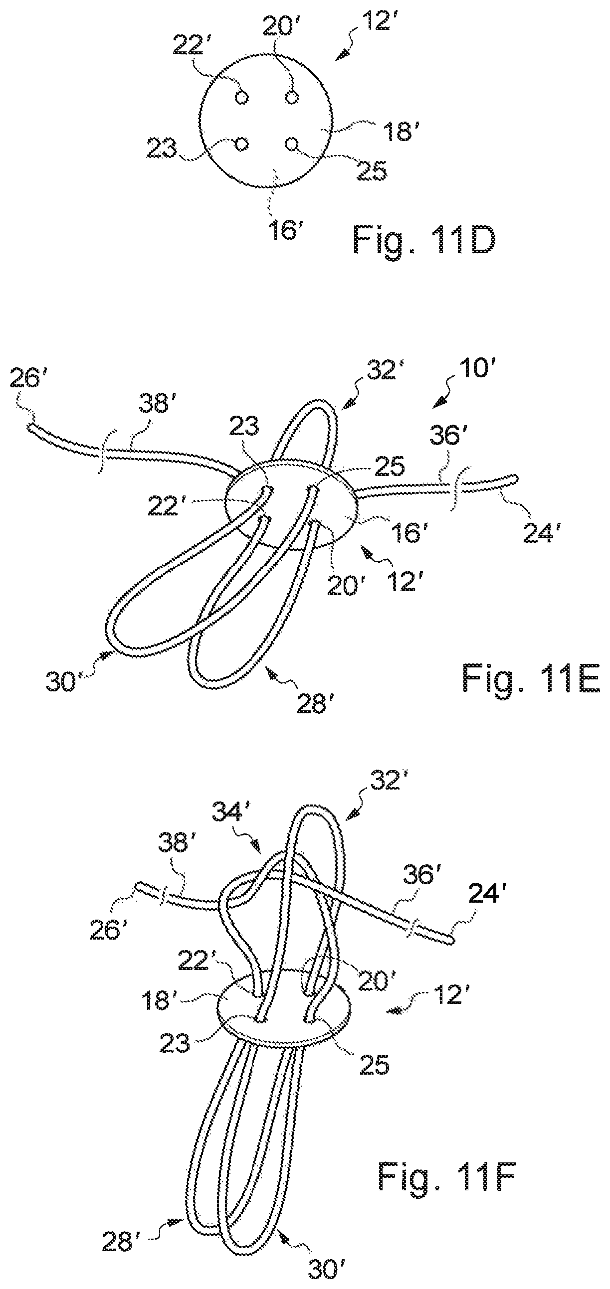 Patent US12310840 Figure 15 – Implant assembly and associated methods of manufacturing