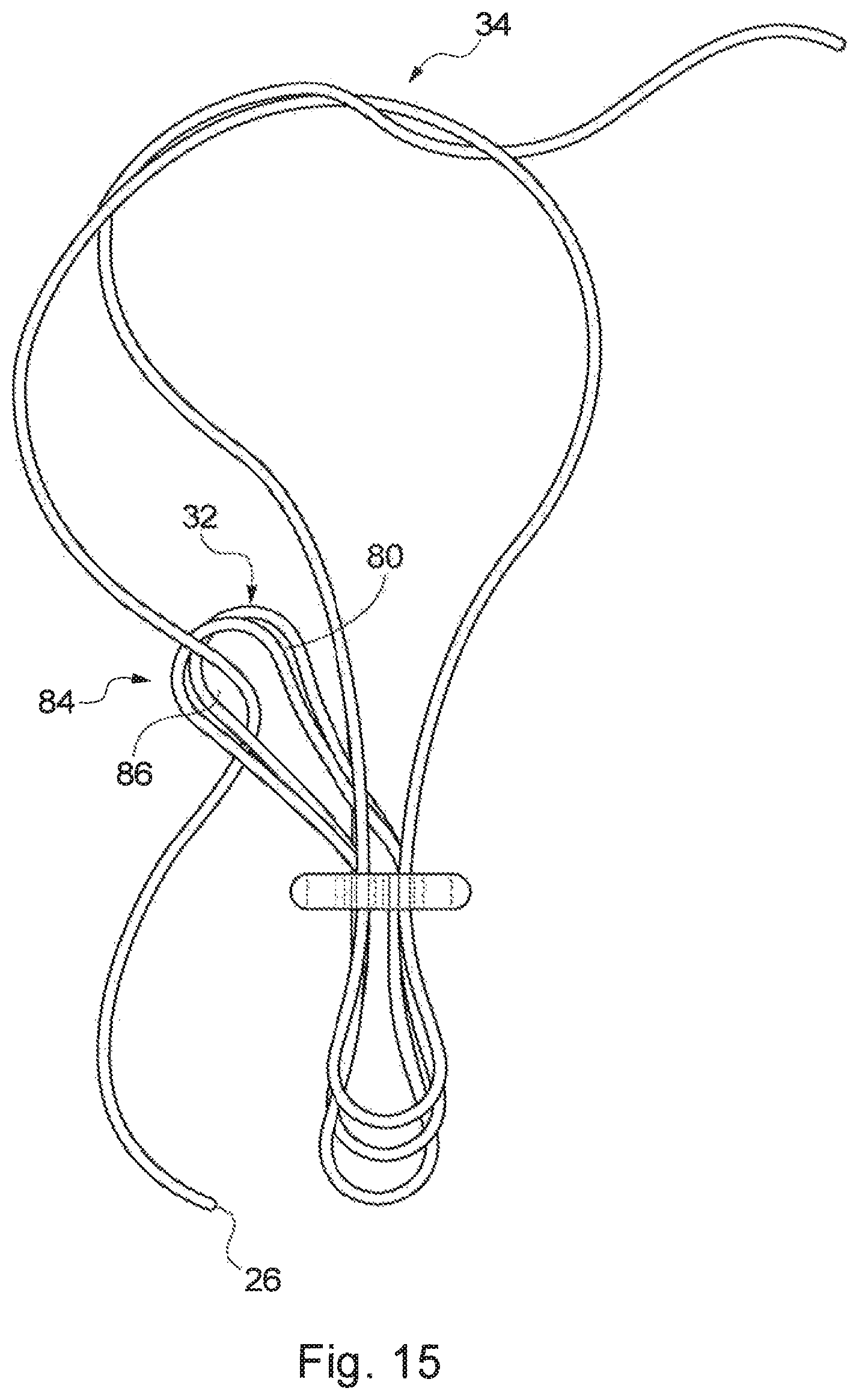 Patent US12310840 Figure 19 – Implant assembly and associated methods of manufacturing