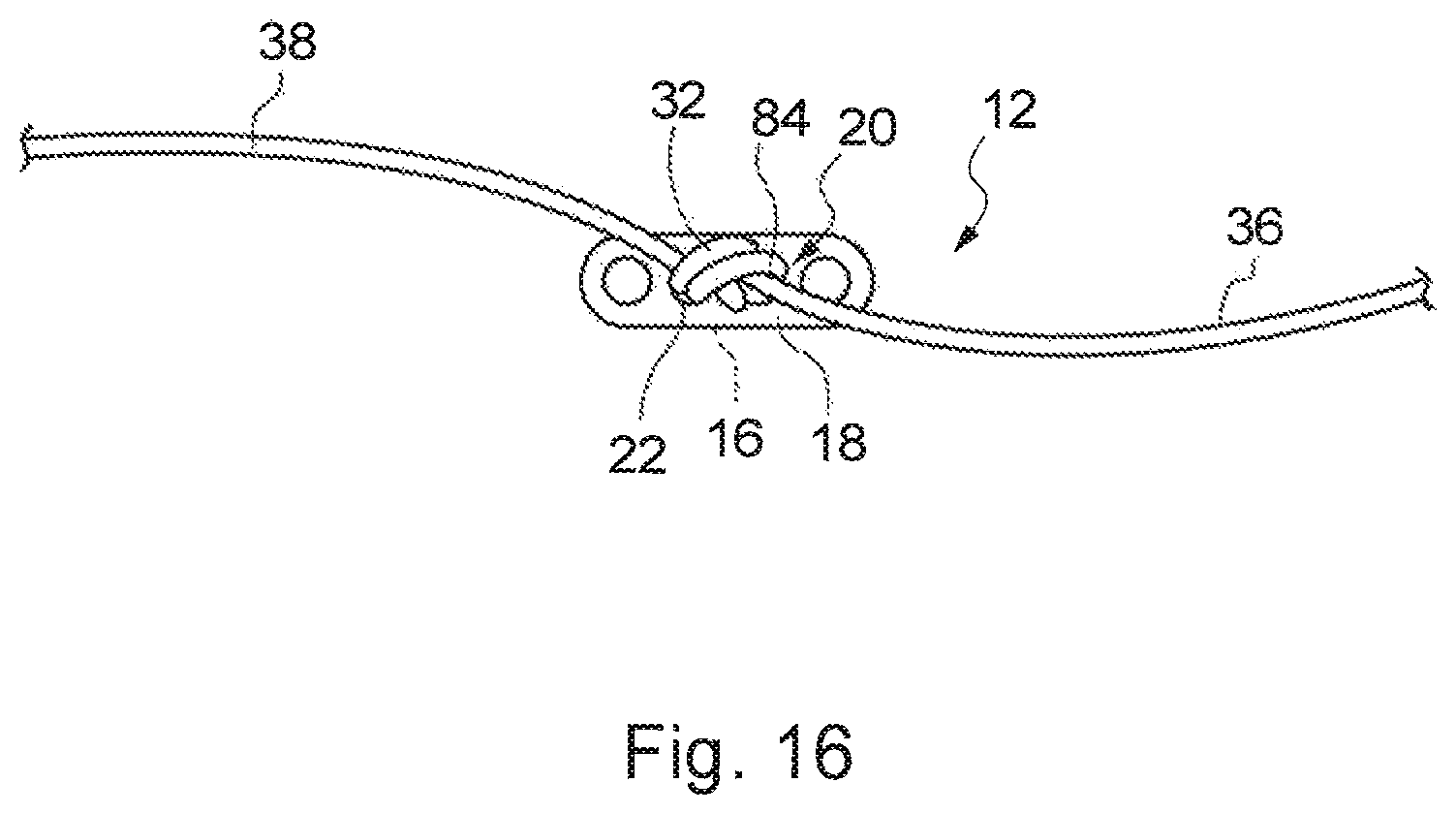 Patent US12310840 Figure 20 – Implant assembly and associated methods of manufacturing