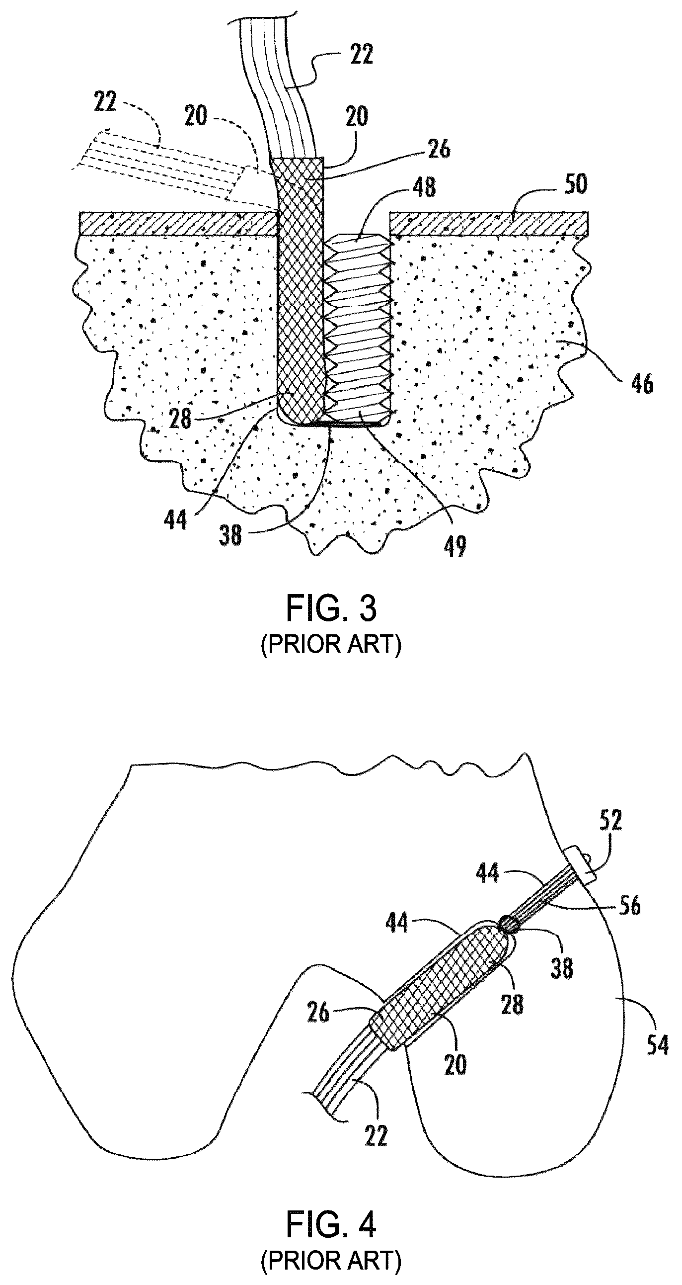Patent US12310841 Figure 2 – Fibrous connective tissue protective device, method of manufacturing, and surgical method