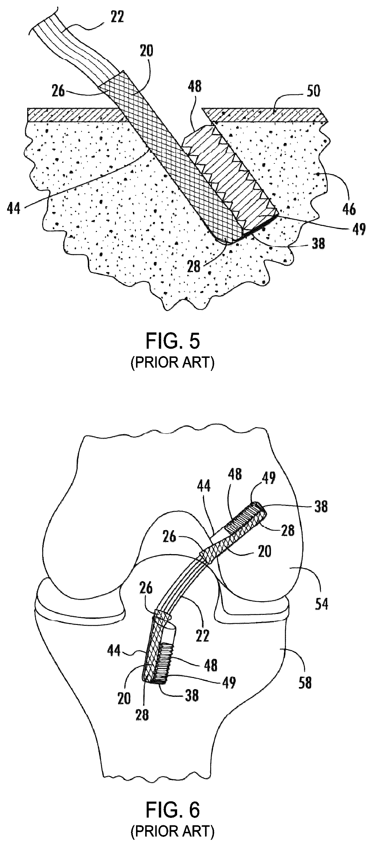 Patent US12310841 Figure 3 – Fibrous connective tissue protective device, method of manufacturing, and surgical method