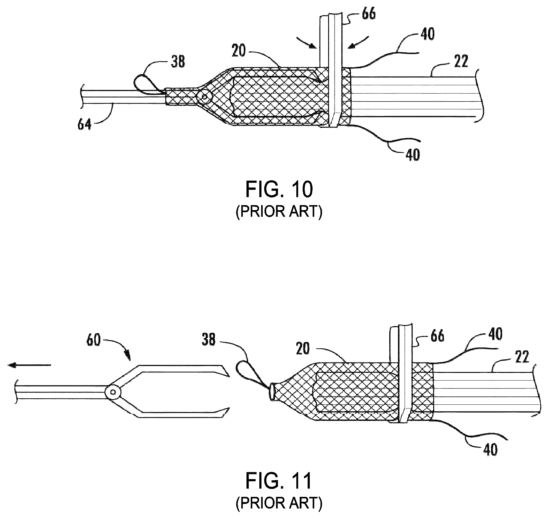 Patent US12310841 Figure 5 – Fibrous connective tissue protective device, method of manufacturing, and surgical method
