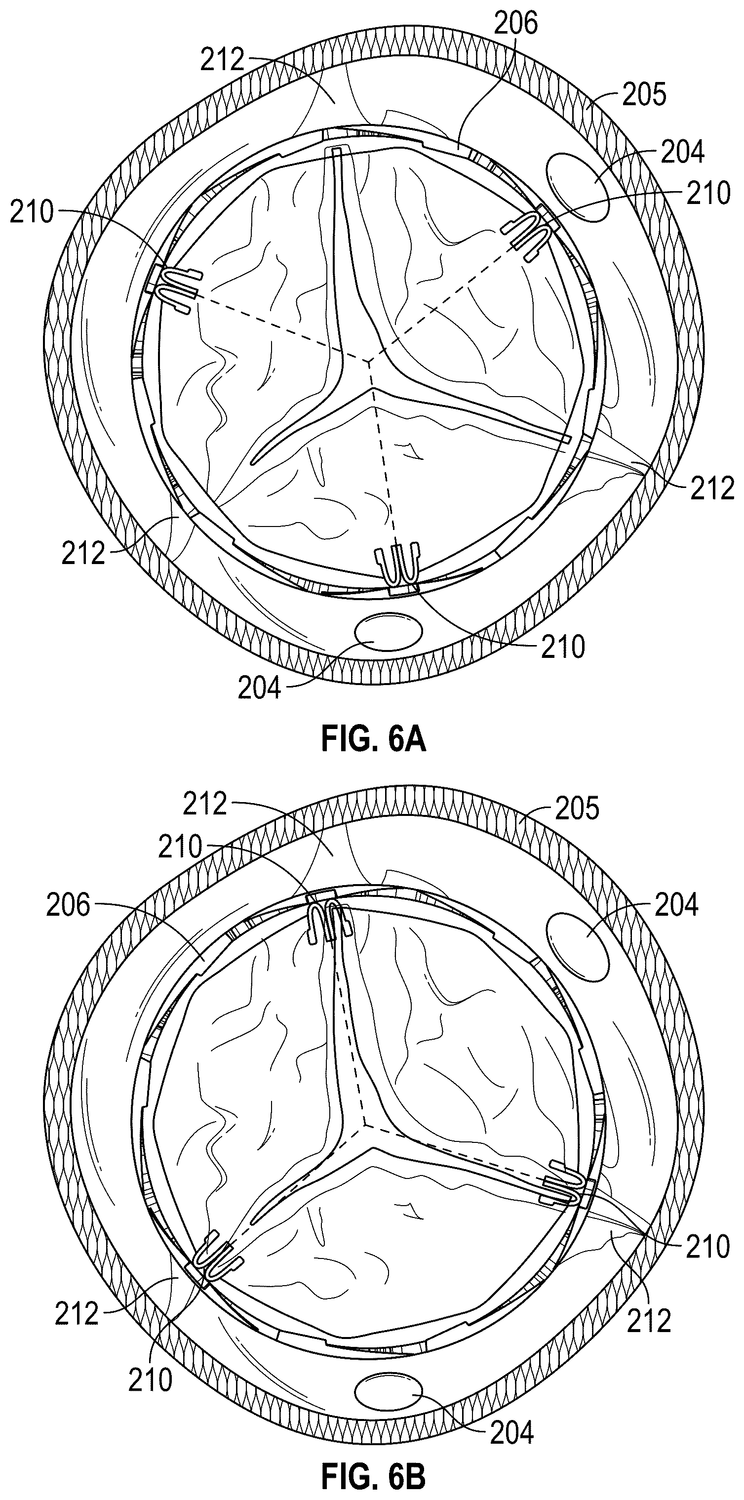 Patent US12310843 Figure 5 – Balloon cover for a delivery apparatus for an expandable prosthetic heart valve