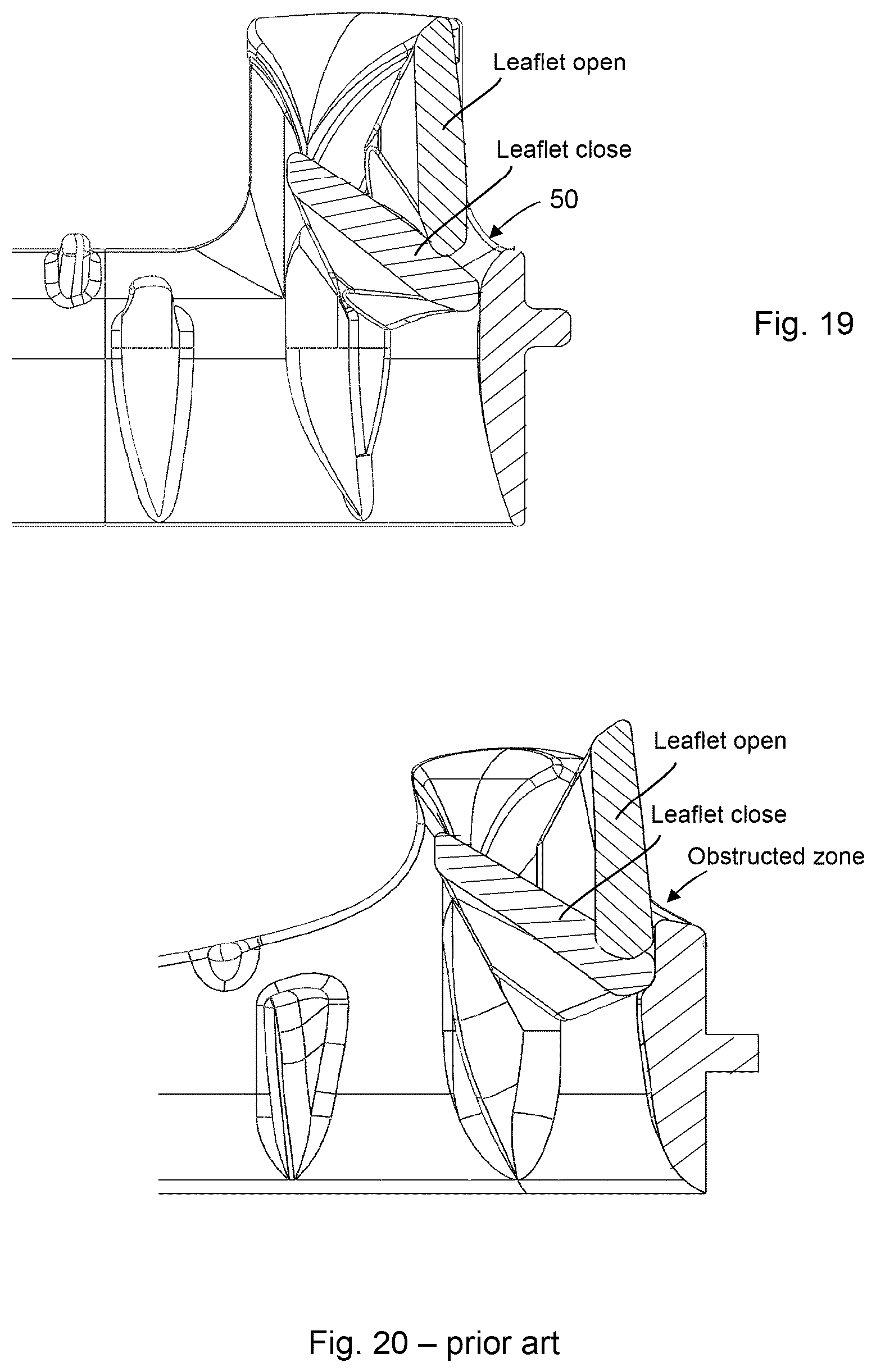 Patent US12310844 Figure 8 – Mechanical prosthetic heart valve