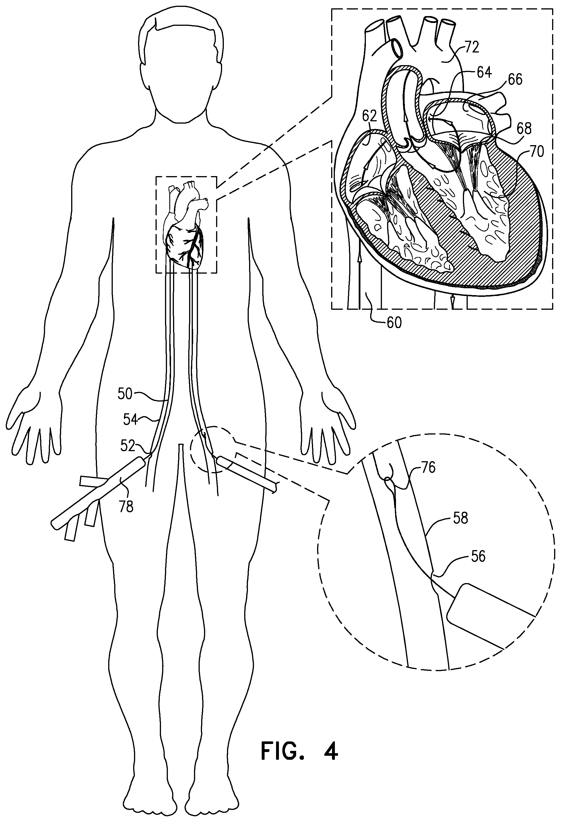 Patent US12310845 Figure 4 – Docking elements