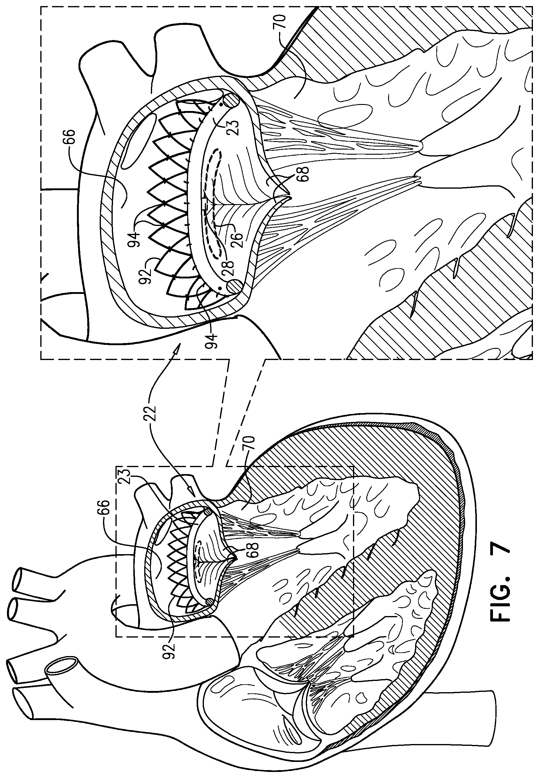 Patent US12310845 Figure 7 – Docking elements