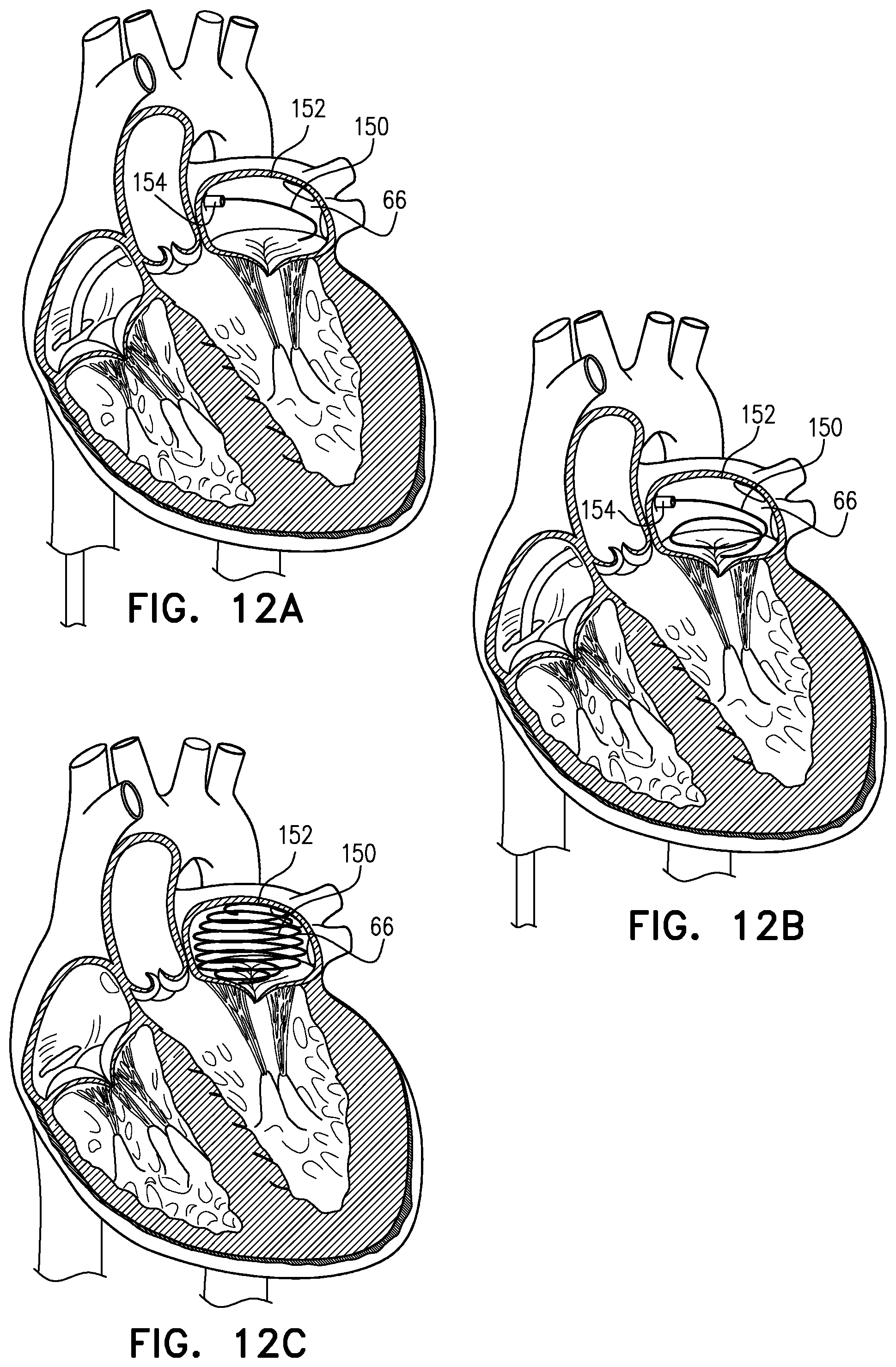 Patent US12310845 Figure 11 – Docking elements