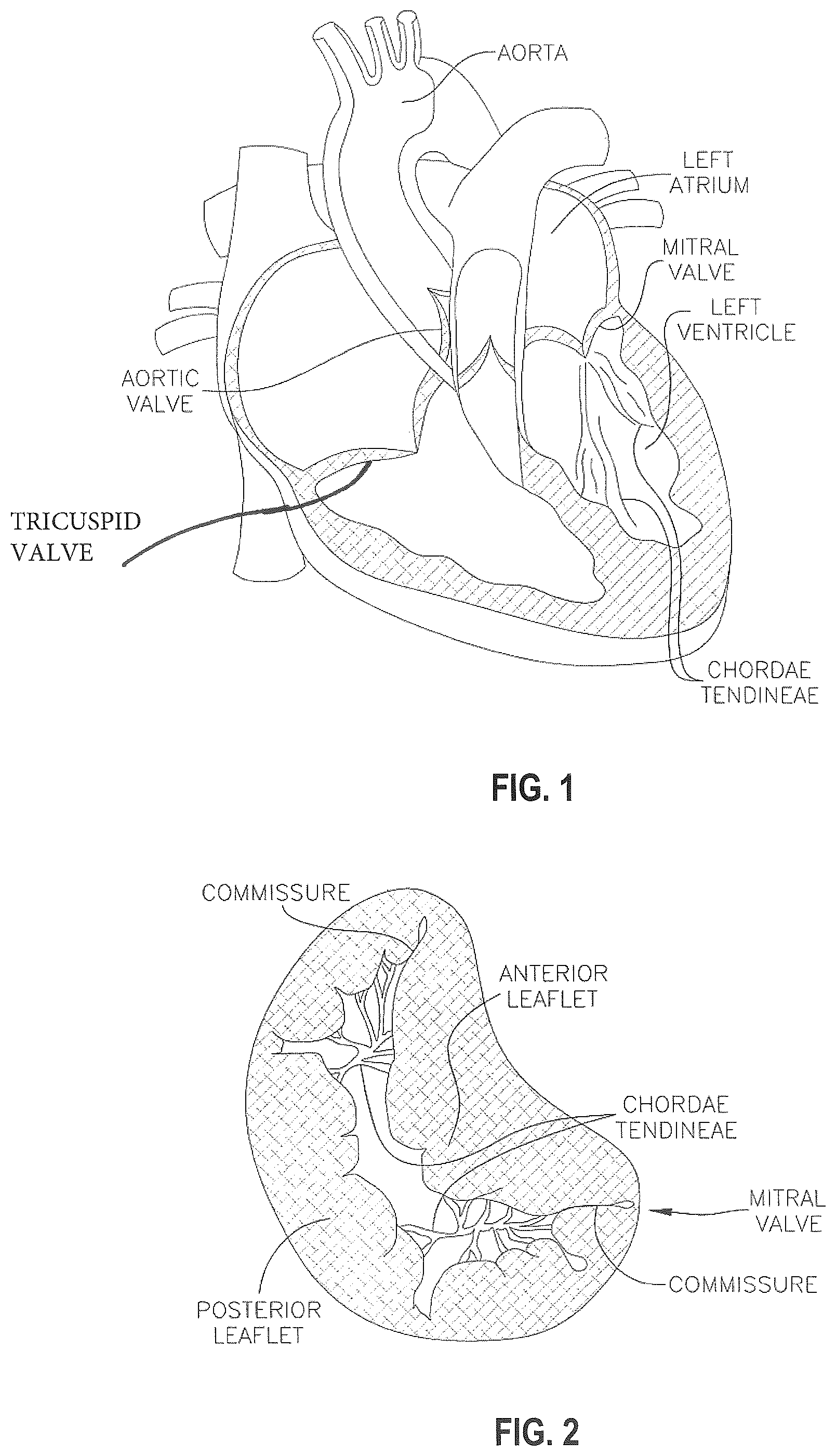 Patent US12310846 Figure 1 – Covered prosthetic heart valve
