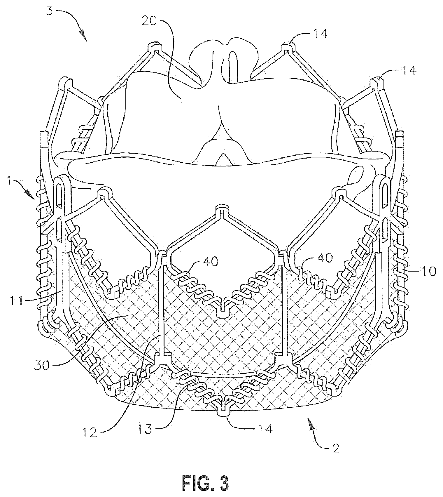 Patent US12310846 Figure 2 – Covered prosthetic heart valve