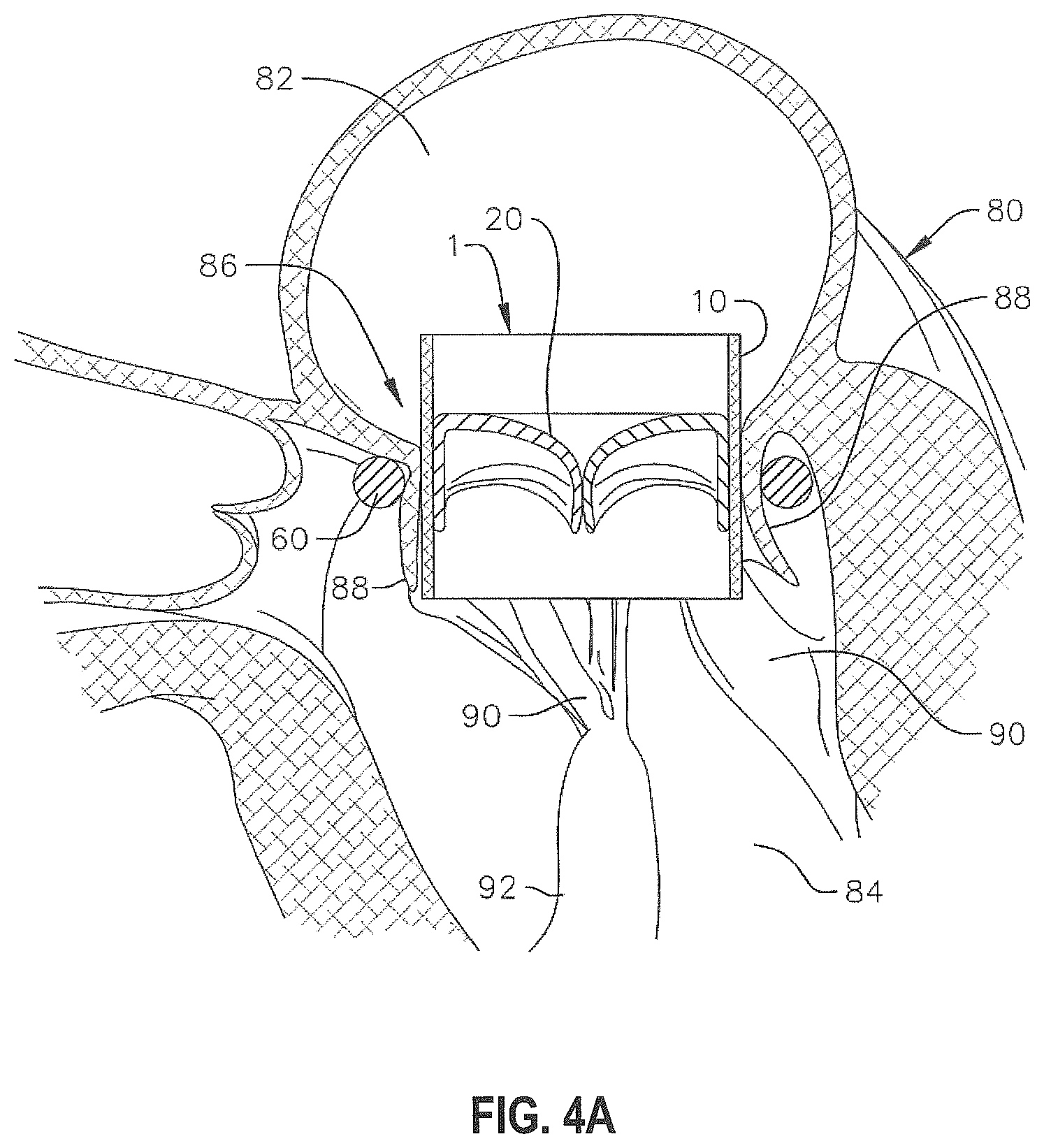 Patent US12310846 Figure 3 – Covered prosthetic heart valve