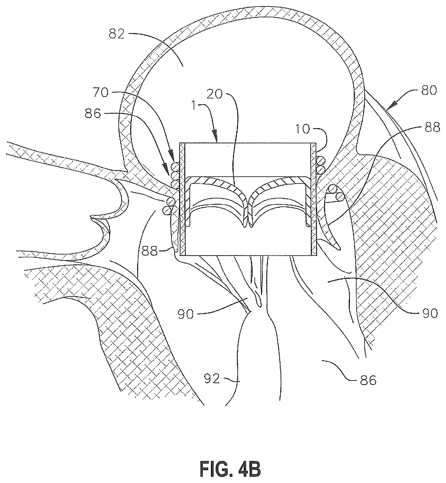 Patent US12310846 Figure 4 – Covered prosthetic heart valve