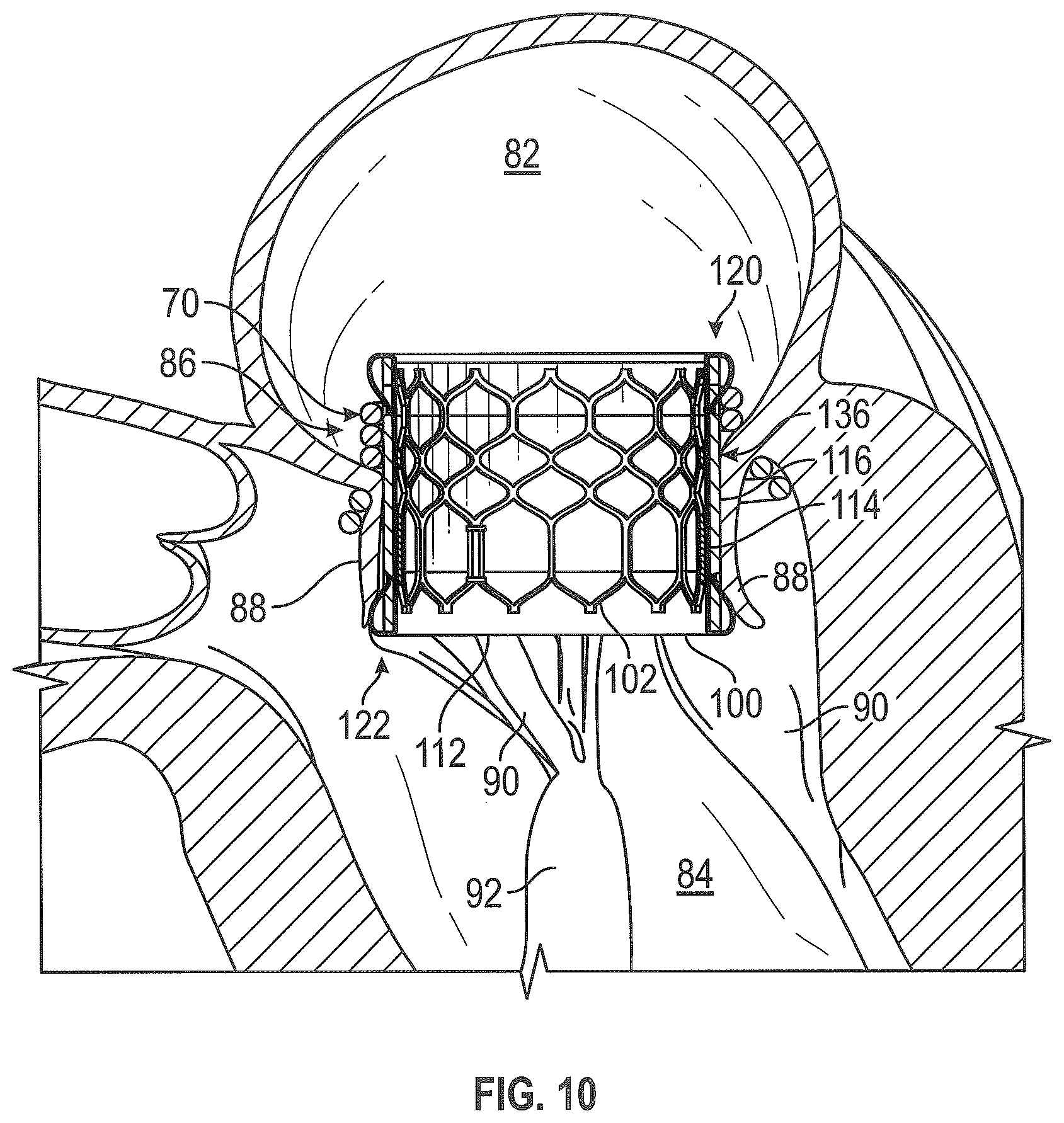 Patent US12310846 Figure 9 – Covered prosthetic heart valve
