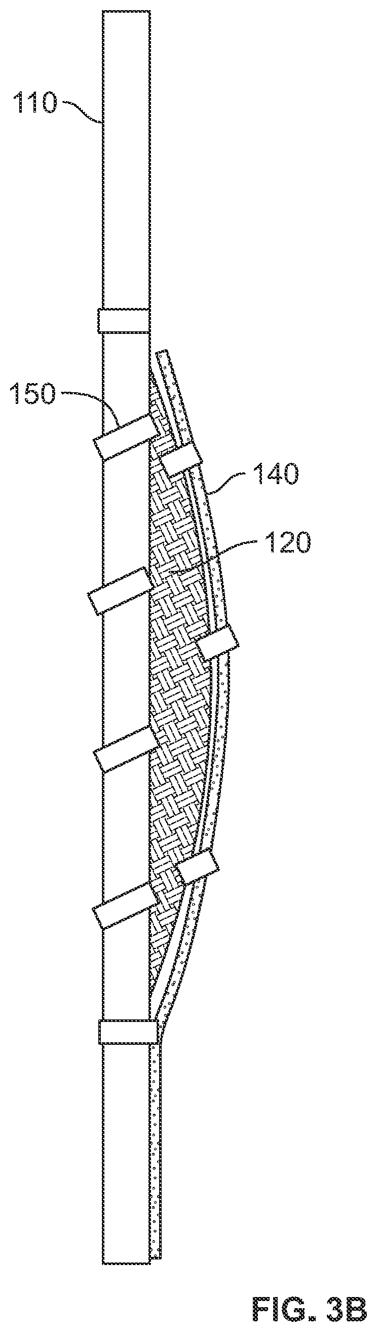 Patent US12310848 Figure 4 – Leaflet attachment to prosthetic heart valve