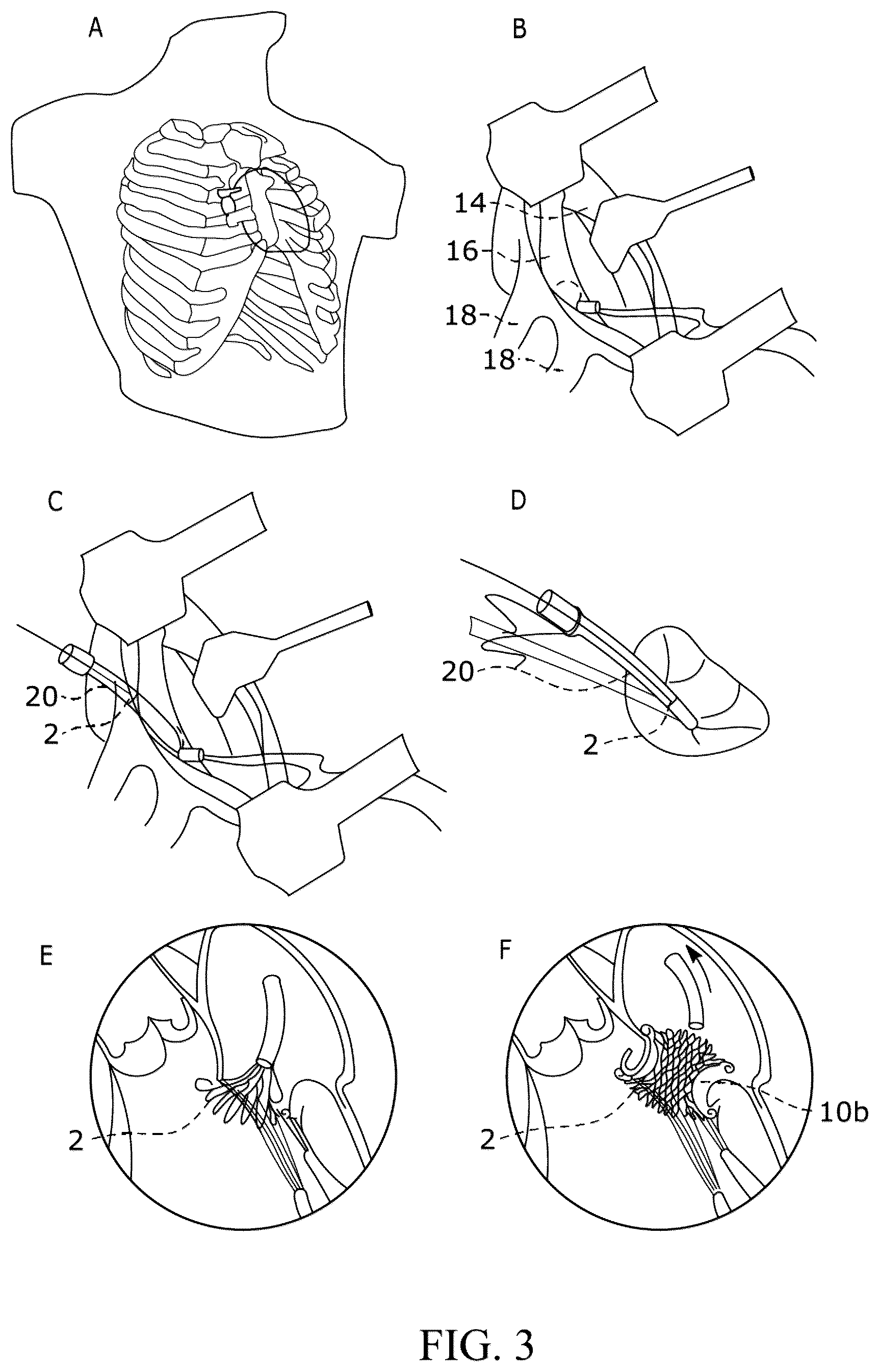 Patent US12310849 Figure 3 – Valve prosthesis