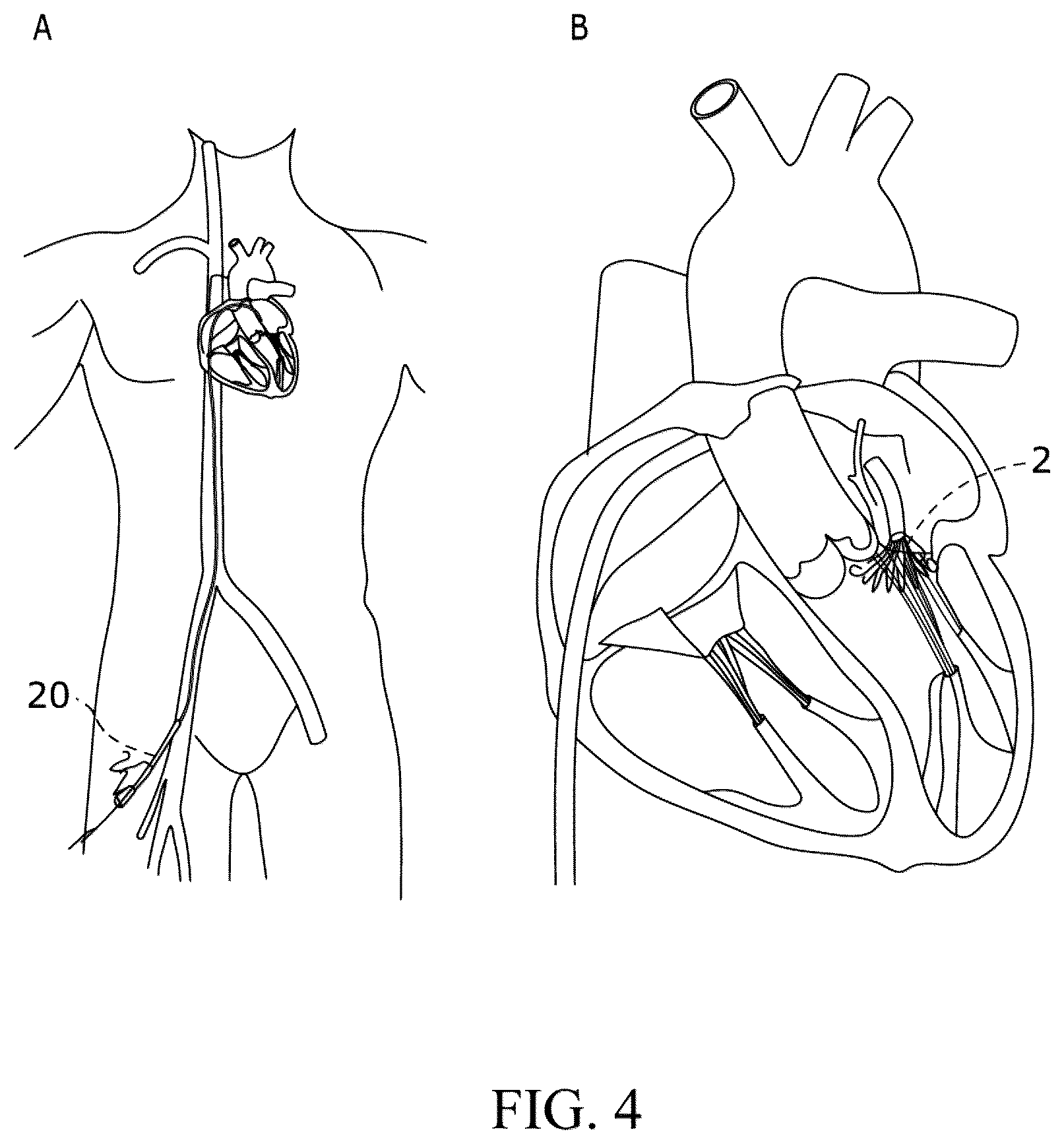 Patent US12310849 Figure 4 – Valve prosthesis