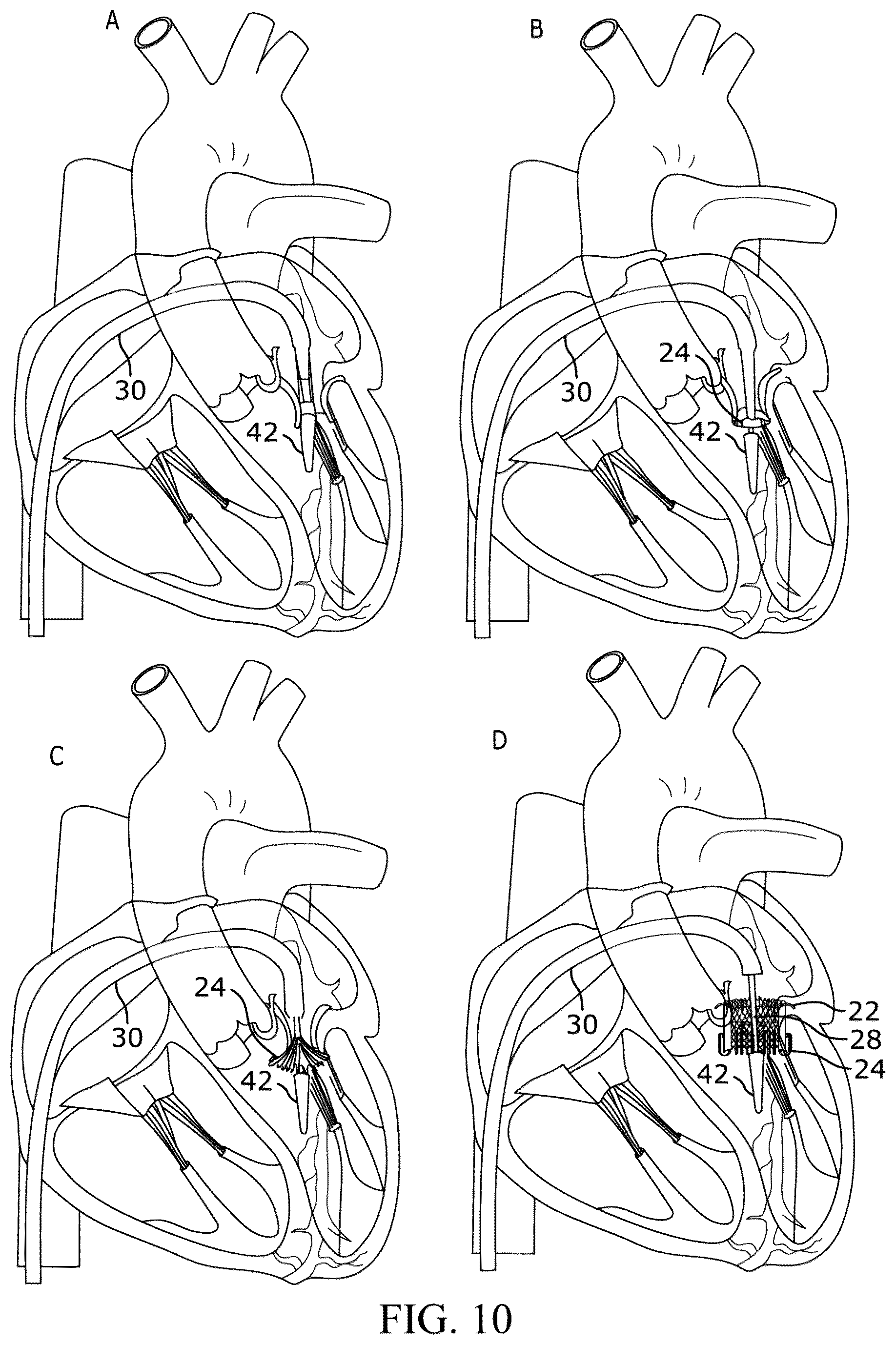 Patent US12310849 Figure 10 – Valve prosthesis