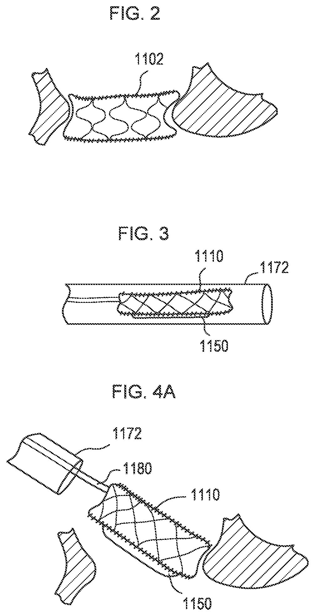 Patent US12310850 Figure 5 – Transcatheter deliverable prosthetic heart valves and methods of delivery