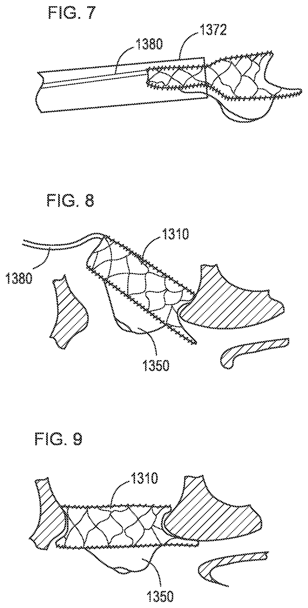 Patent US12310850 Figure 7 – Transcatheter deliverable prosthetic heart valves and methods of delivery