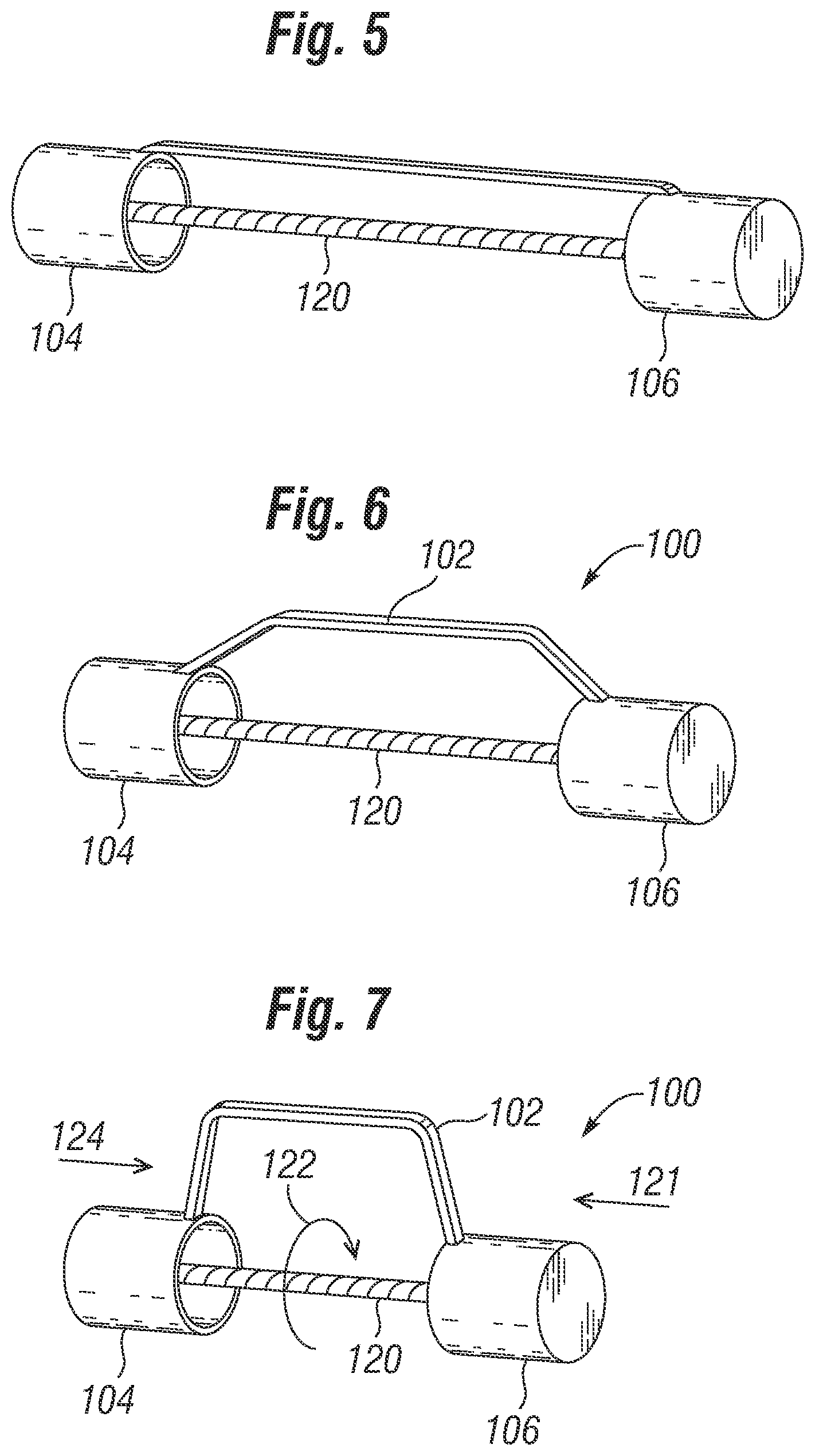 Patent US12310851 Figure 2 – Method for deploying a prosthetic heart valve