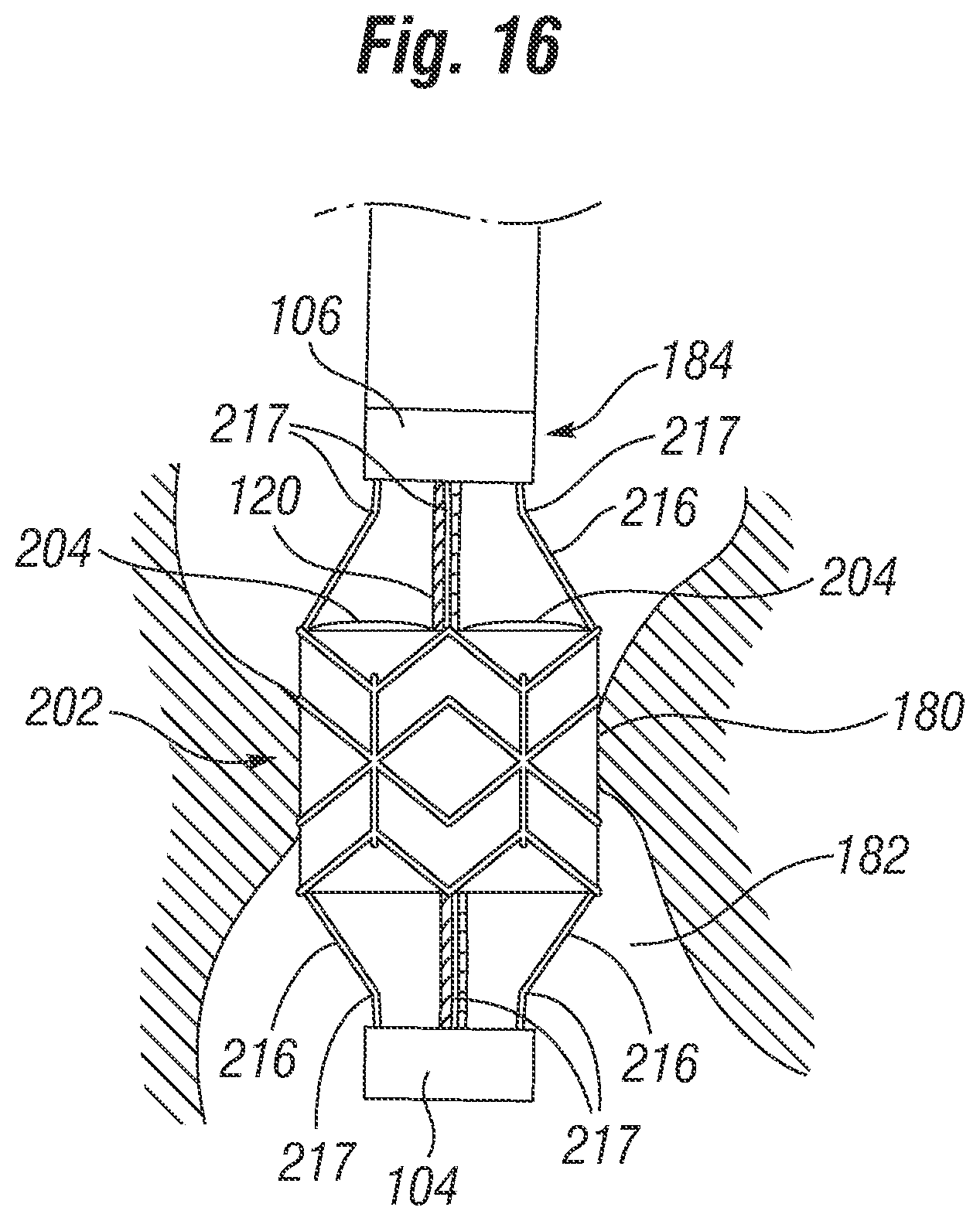 Patent US12310851 Figure 9 – Method for deploying a prosthetic heart valve