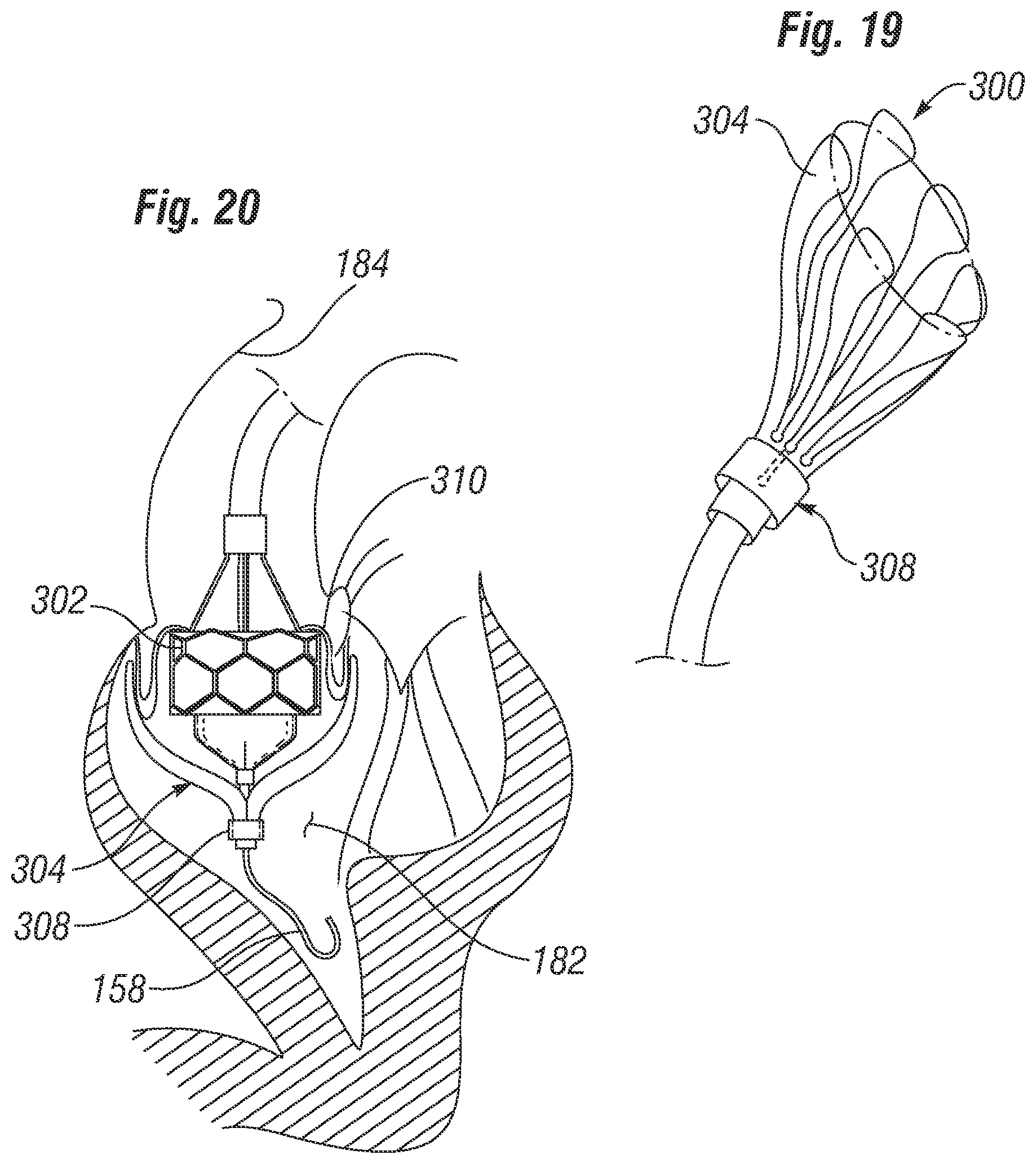 Patent US12310851 Figure 12 – Method for deploying a prosthetic heart valve
