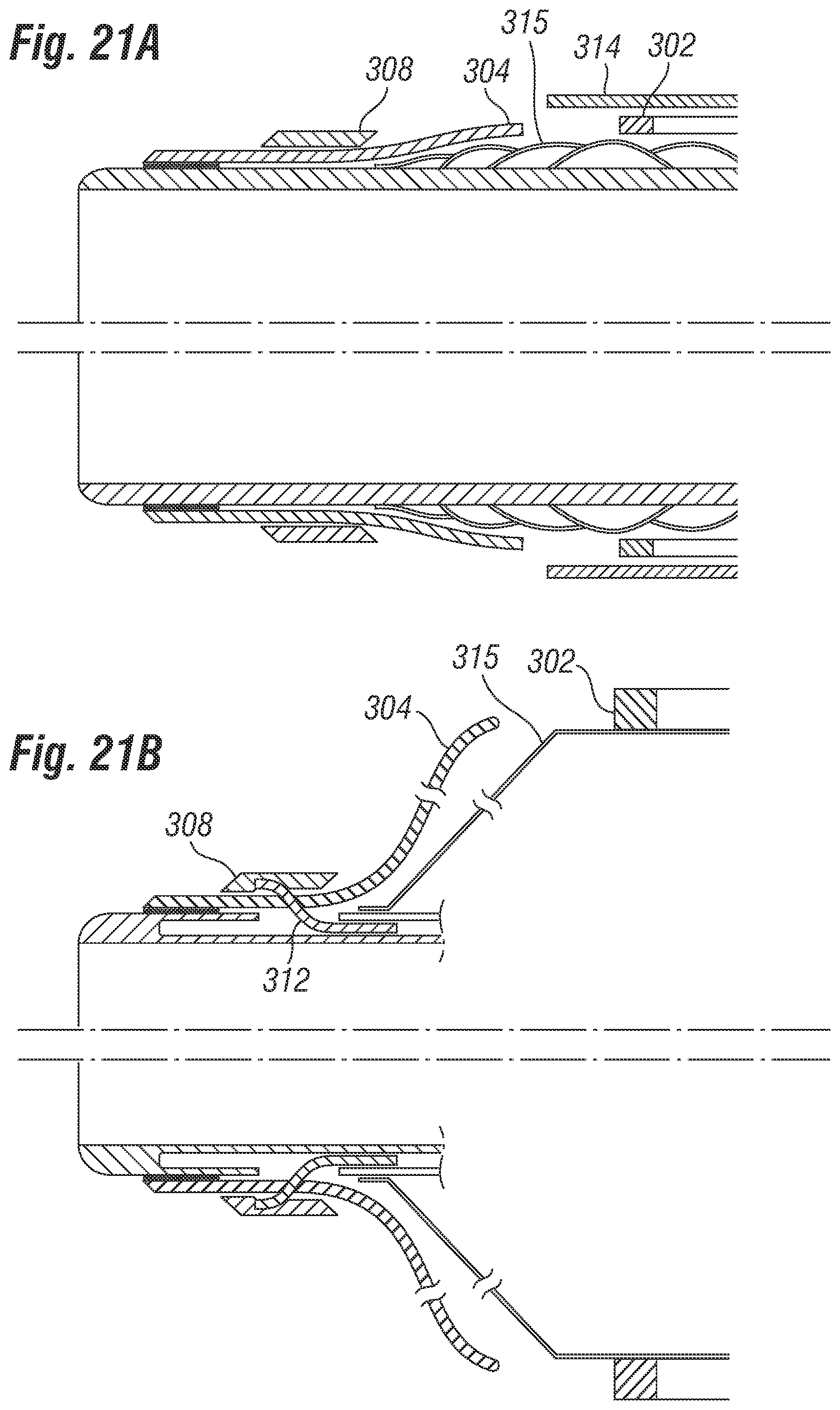 Patent US12310851 Figure 13 – Method for deploying a prosthetic heart valve