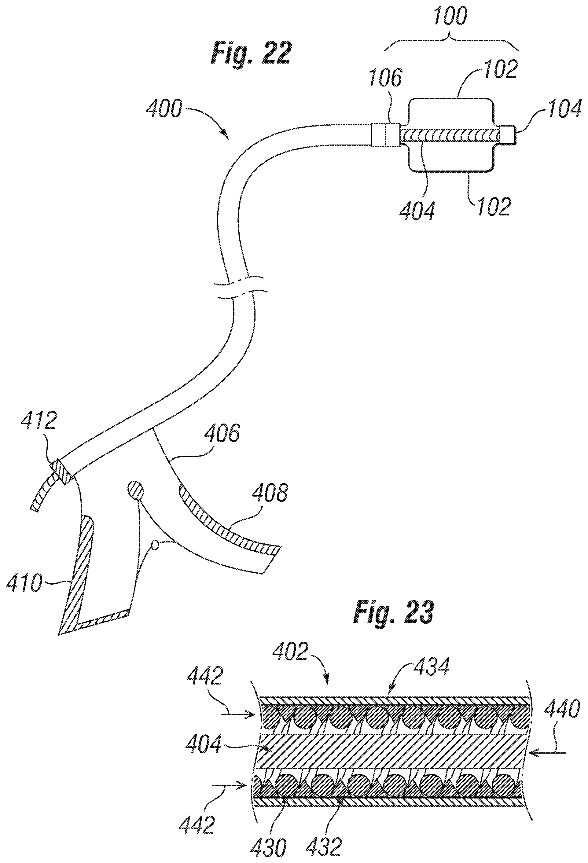 Patent US12310851 Figure 14 – Method for deploying a prosthetic heart valve