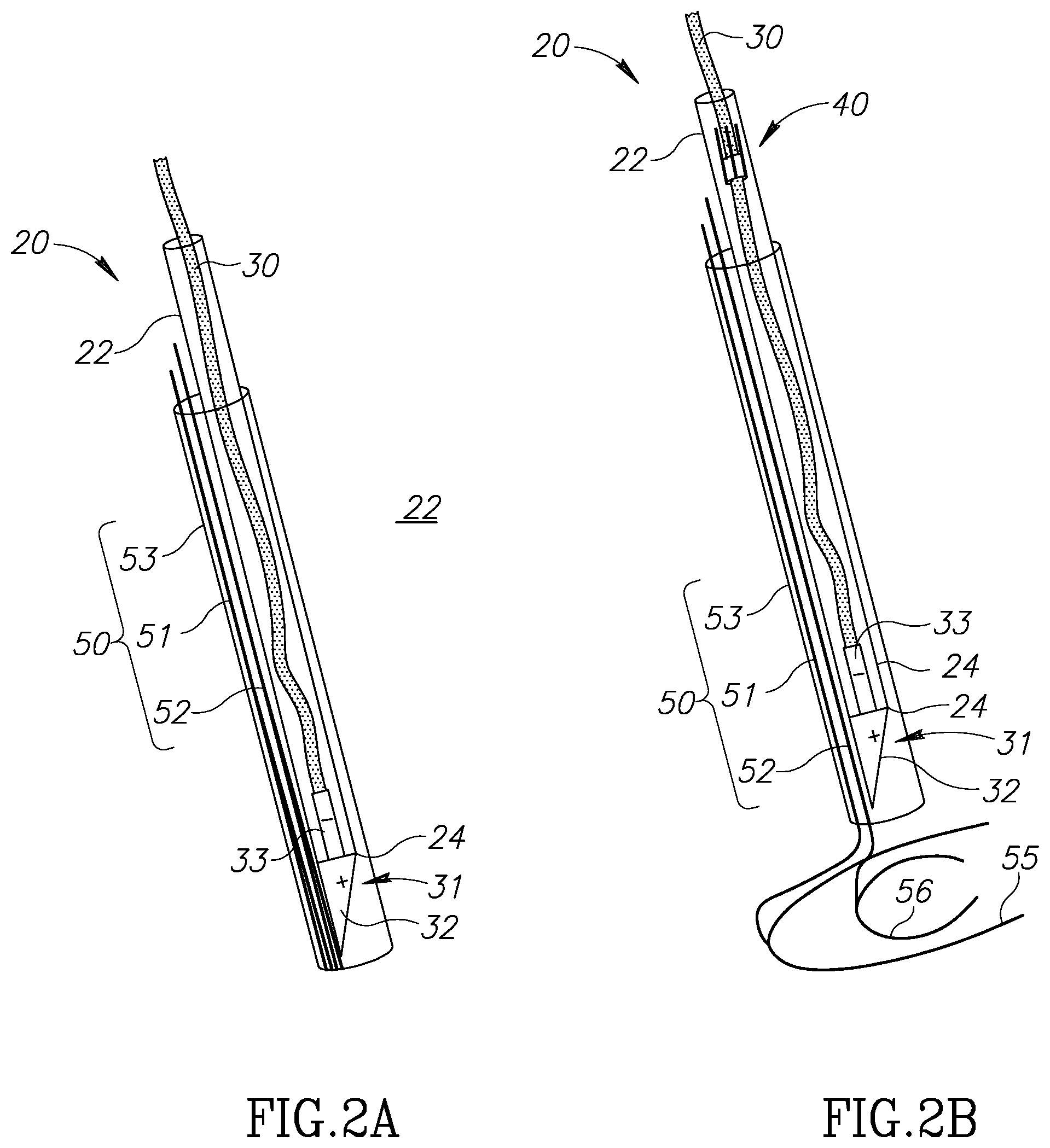 Patent US12310852 Figure 2 – Chorda replacement apparatus and method