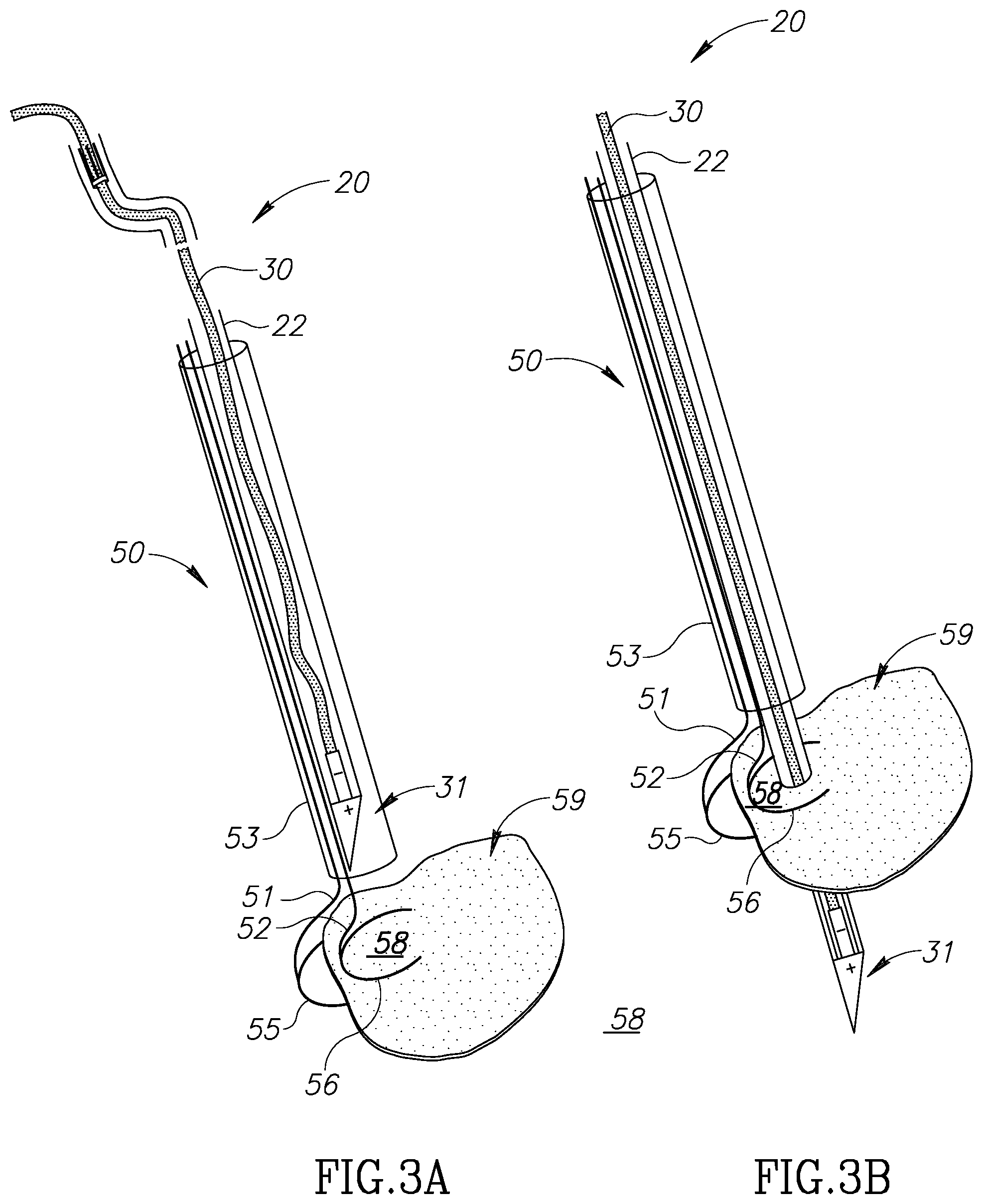 Patent US12310852 Figure 3 – Chorda replacement apparatus and method