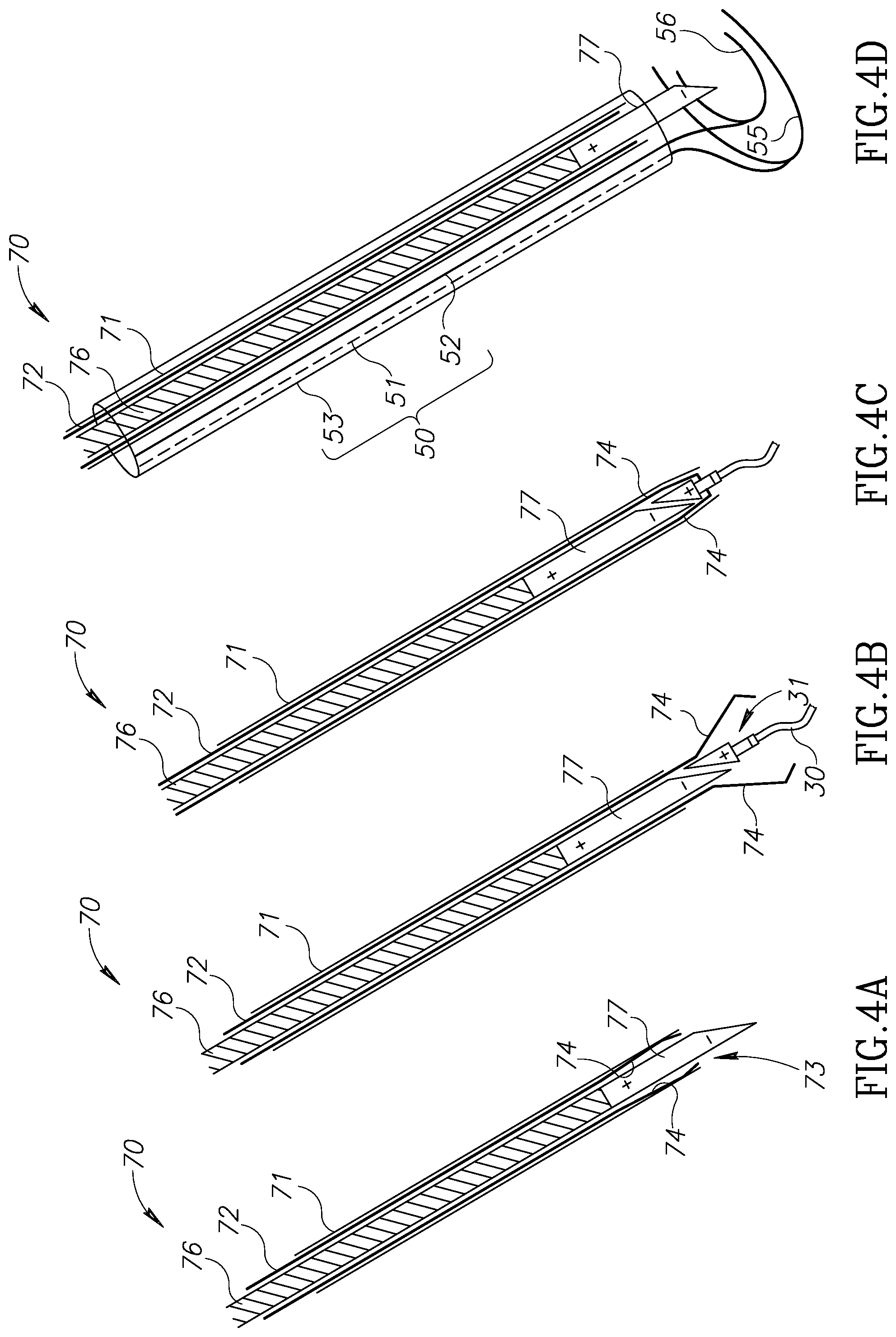 Patent US12310852 Figure 4 – Chorda replacement apparatus and method