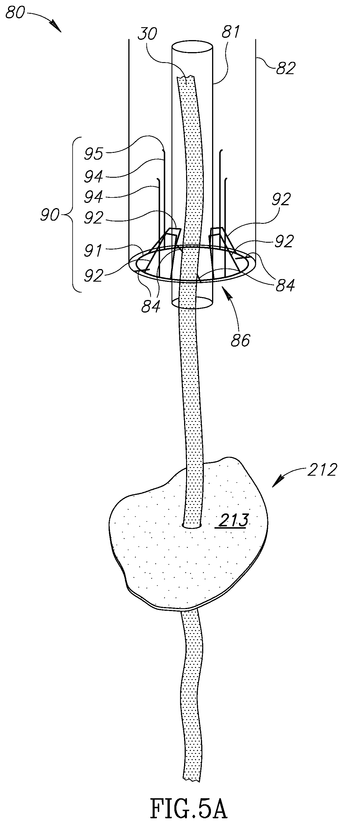 Patent US12310852 Figure 5 – Chorda replacement apparatus and method