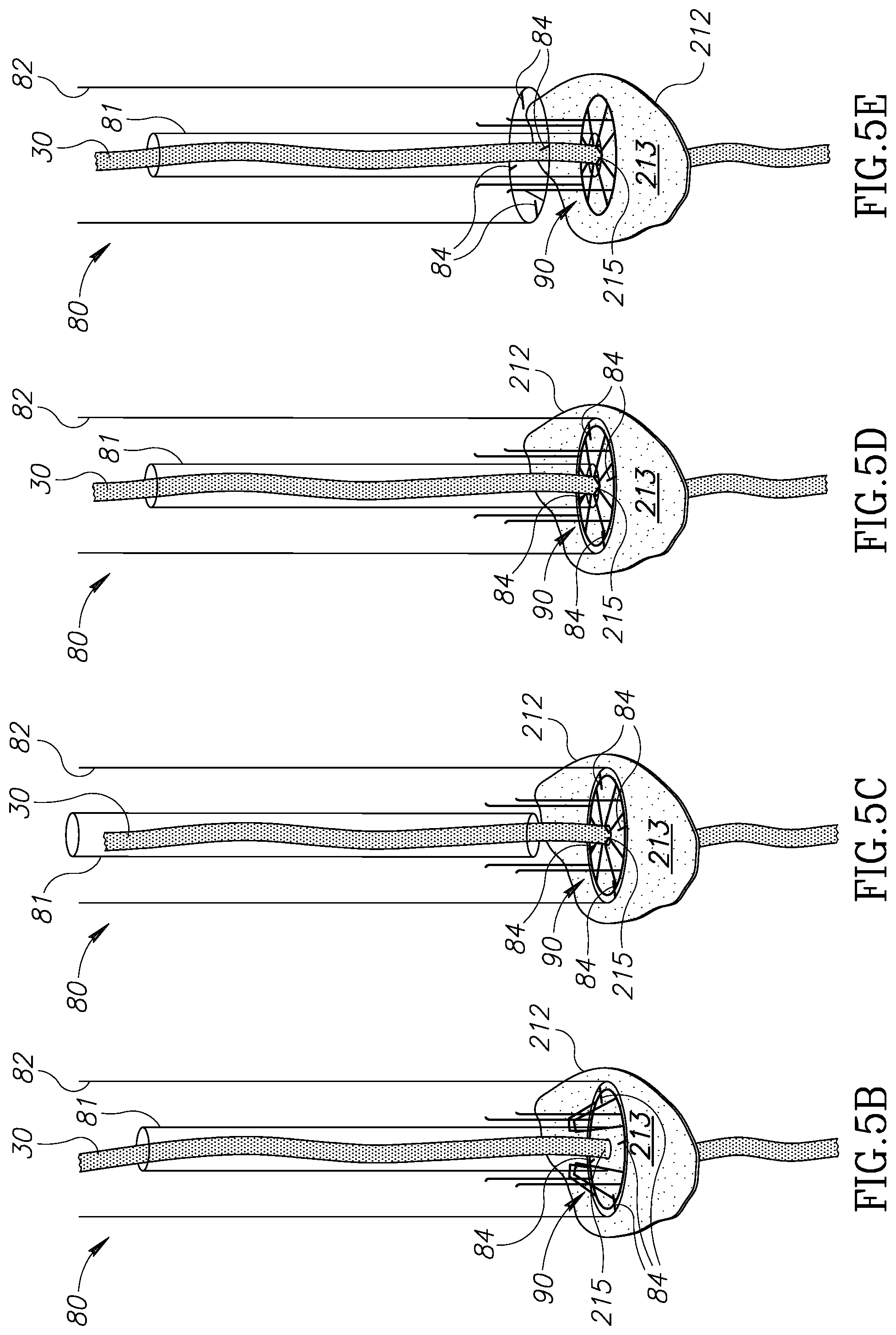 Patent US12310852 Figure 6 – Chorda replacement apparatus and method