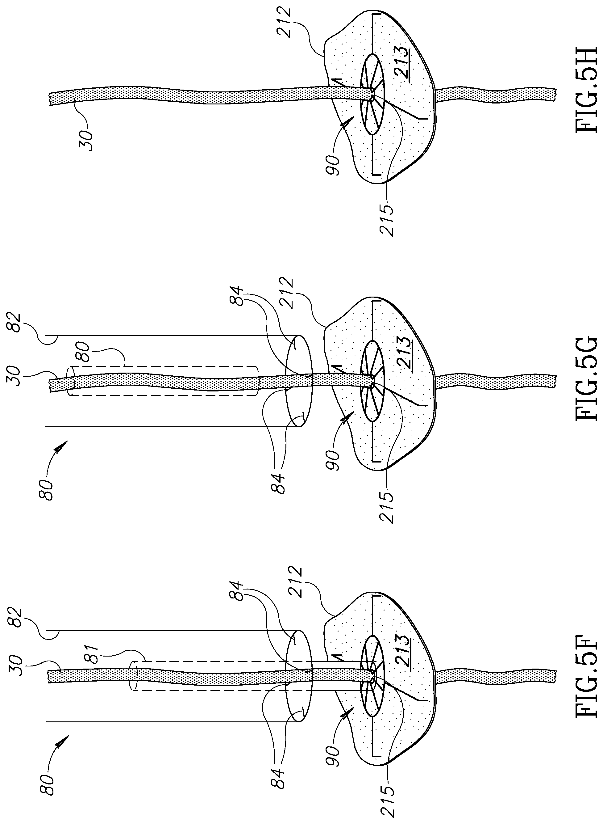 Patent US12310852 Figure 7 – Chorda replacement apparatus and method