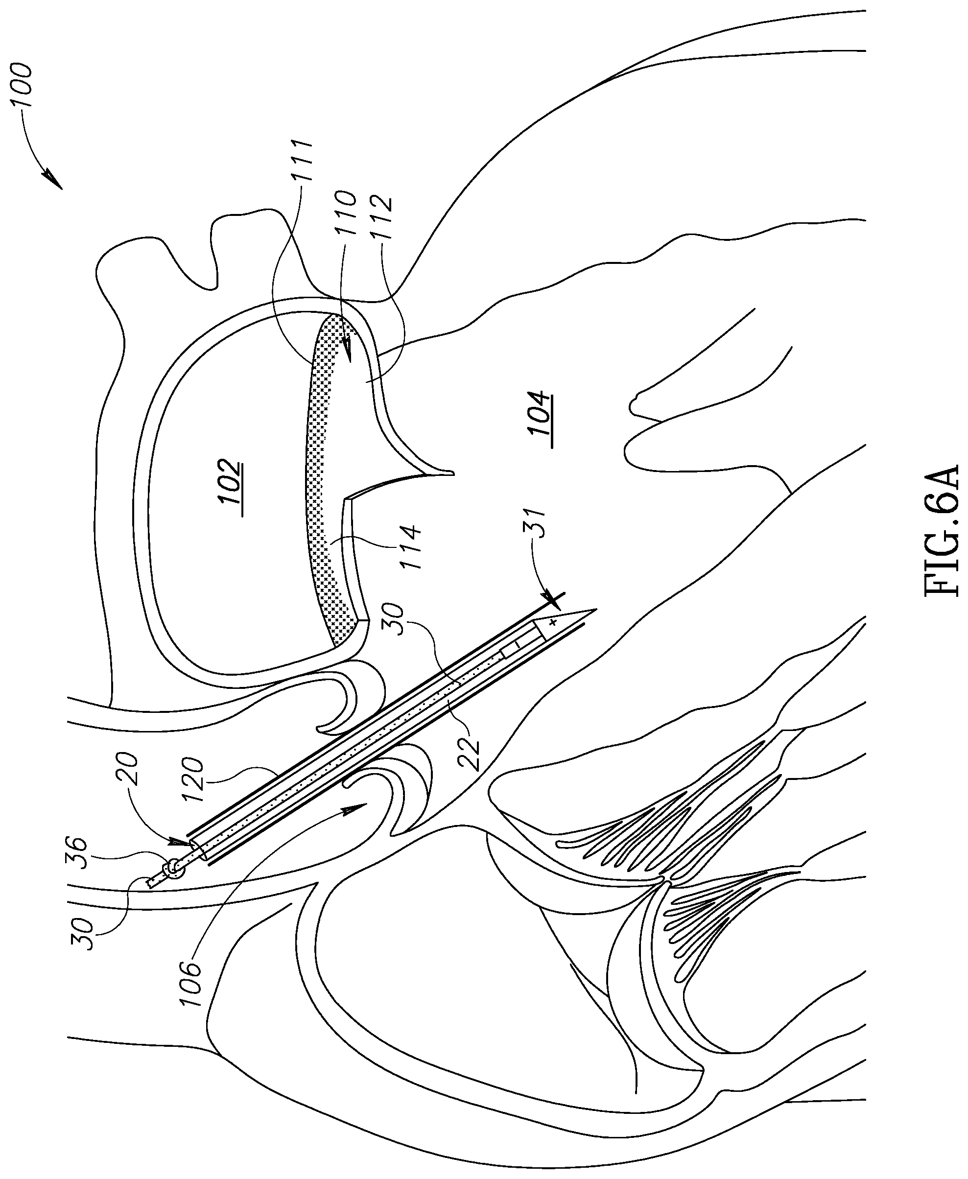 Patent US12310852 Figure 8 – Chorda replacement apparatus and method