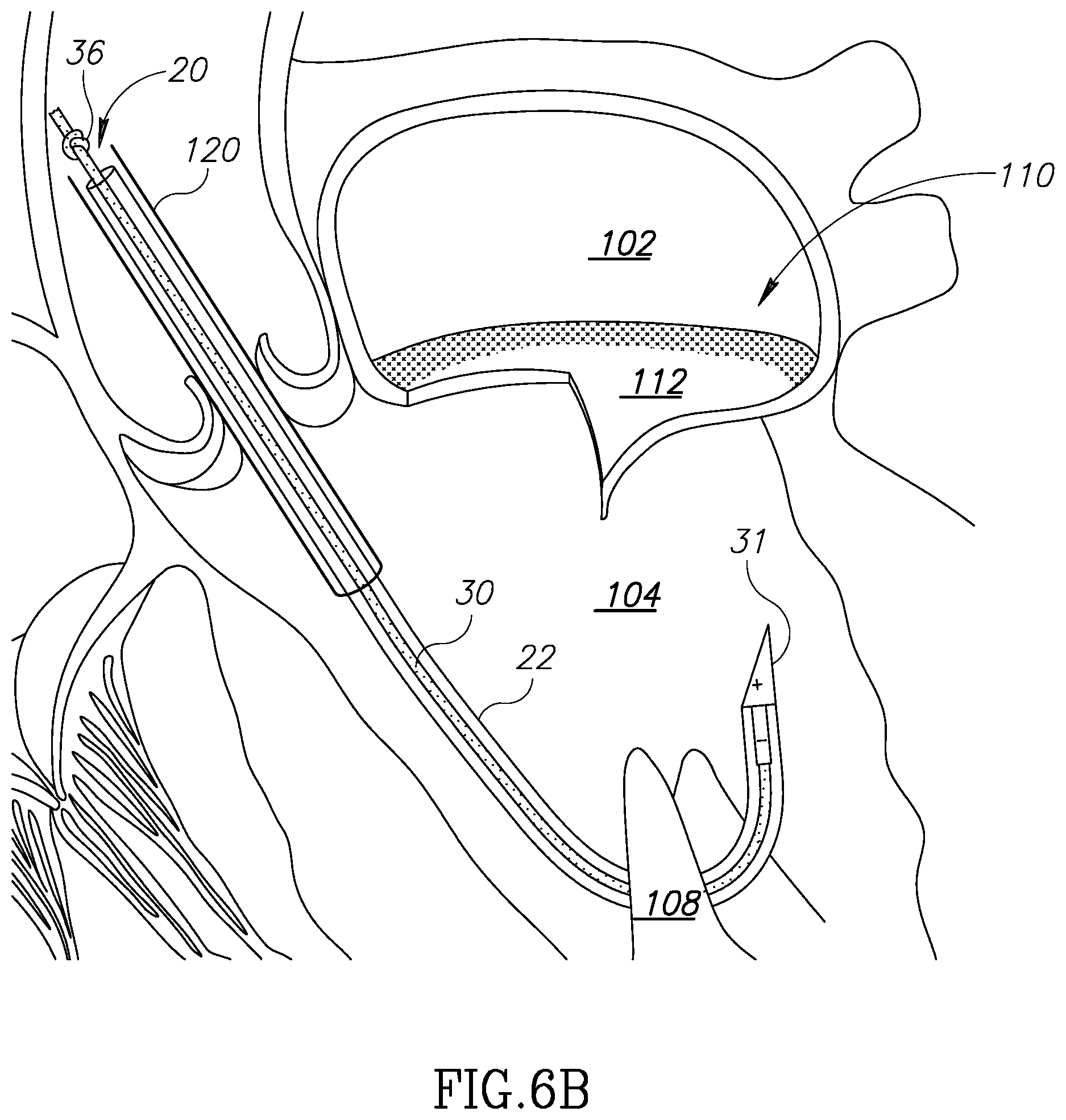 Patent US12310852 Figure 9 – Chorda replacement apparatus and method