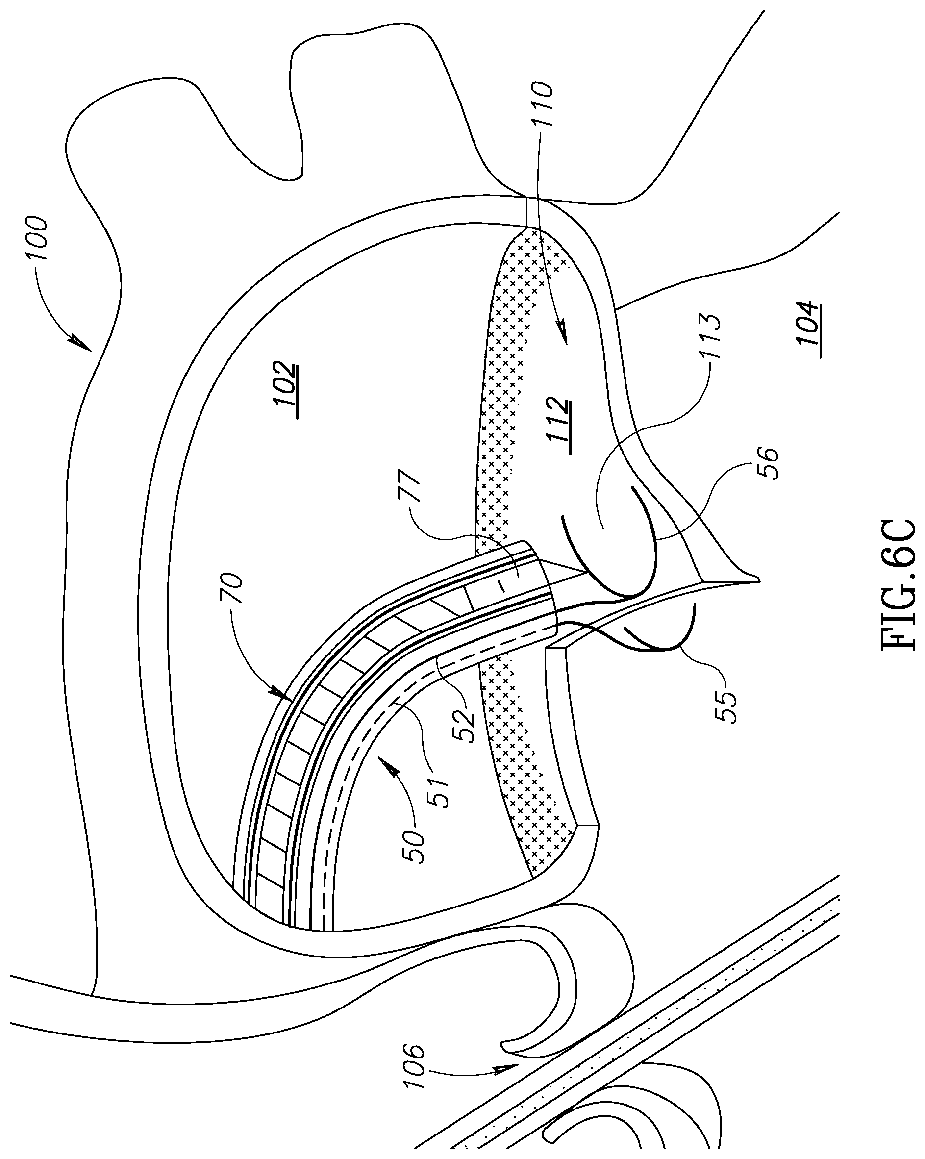 Patent US12310852 Figure 10 – Chorda replacement apparatus and method